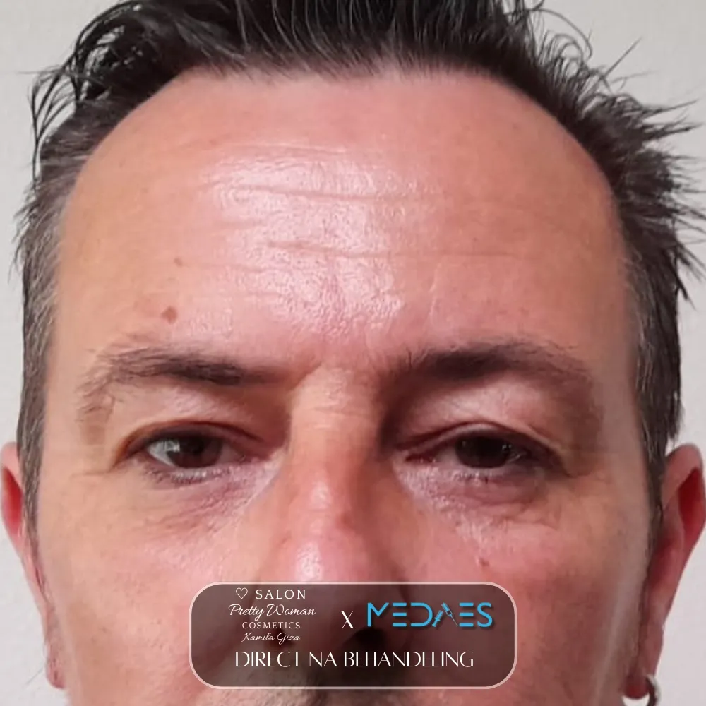 resultaten gezicht lifting met BioPen T6-SALON PRETTY WOMAN-M01-direct na behandeling-04