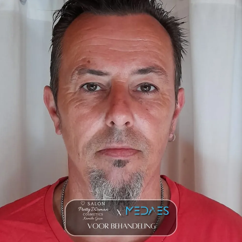 resultaten gezicht lifting met BioPen T6-SALON PRETTY WOMAN-M01-voor behandeling-01