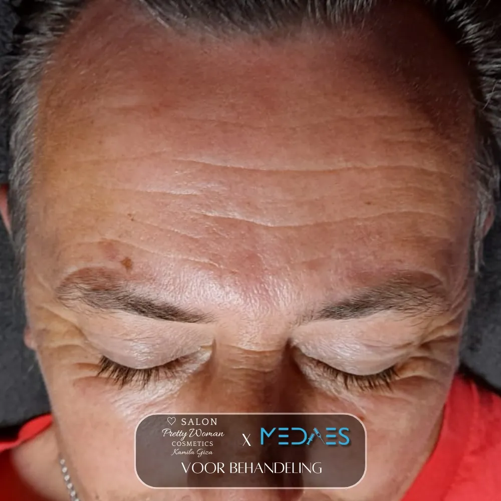 resultaten gezicht lifting met BioPen T6-SALON PRETTY WOMAN-M01-voor behandeling-03