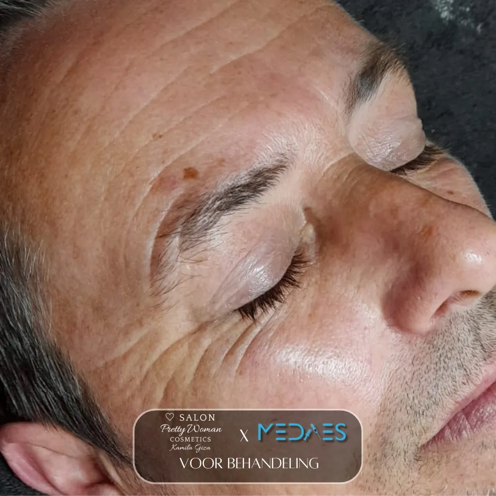 resultaten gezicht lifting met BioPen T6-SALON PRETTY WOMAN-M01-voor behandeling-06