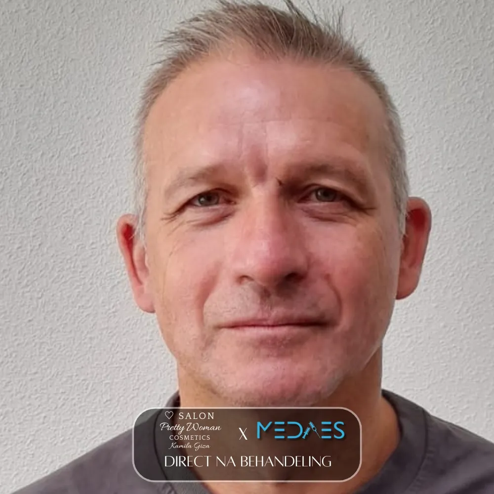 resultaten gezicht lifting met BioPen T6-SALON PRETTY WOMAN-M02-direct na behandeling-02