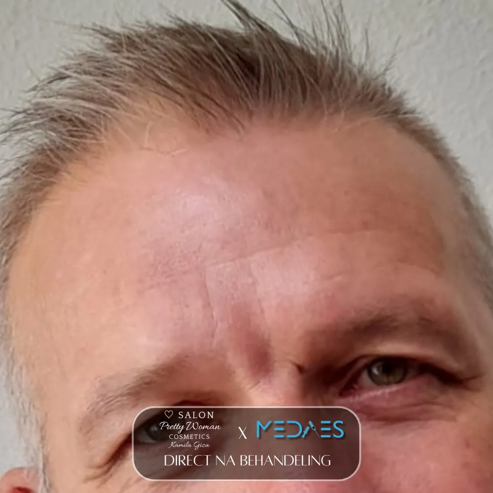 resultaten gezicht lifting met BioPen T6-SALON PRETTY WOMAN-M02-direct na behandeling-04