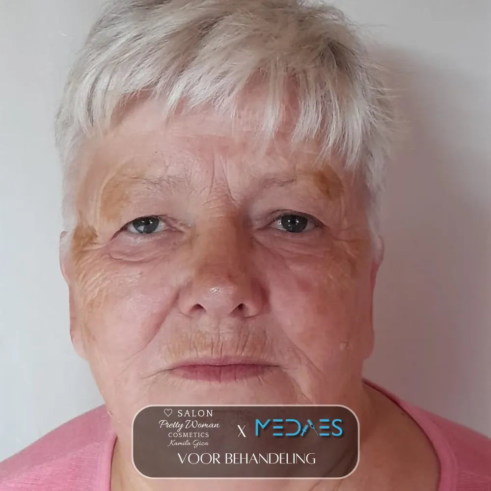 resultaten gezicht lifting met BioPen T6-SALON PRETTY WOMAN-M03-voor behandeling-01