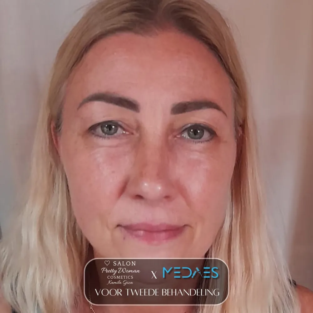 resultaten gezicht lifting met BioPen T6-SALON PRETTY WOMAN-M04-voor behandeling-01