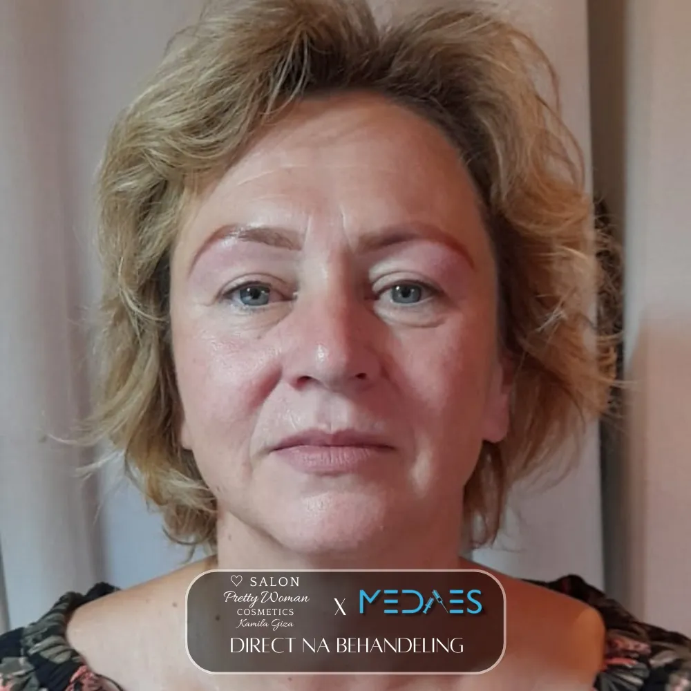 resultaten gezicht lifting met BioPen T6-SALON PRETTY WOMAN-M05-direct na behandeling-02