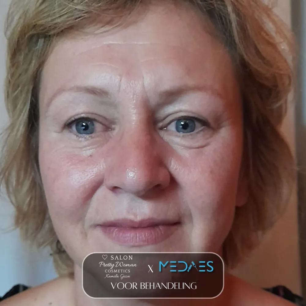 resultaten gezicht lifting met BioPen T6-SALON PRETTY WOMAN-M05-voor behandeling-01