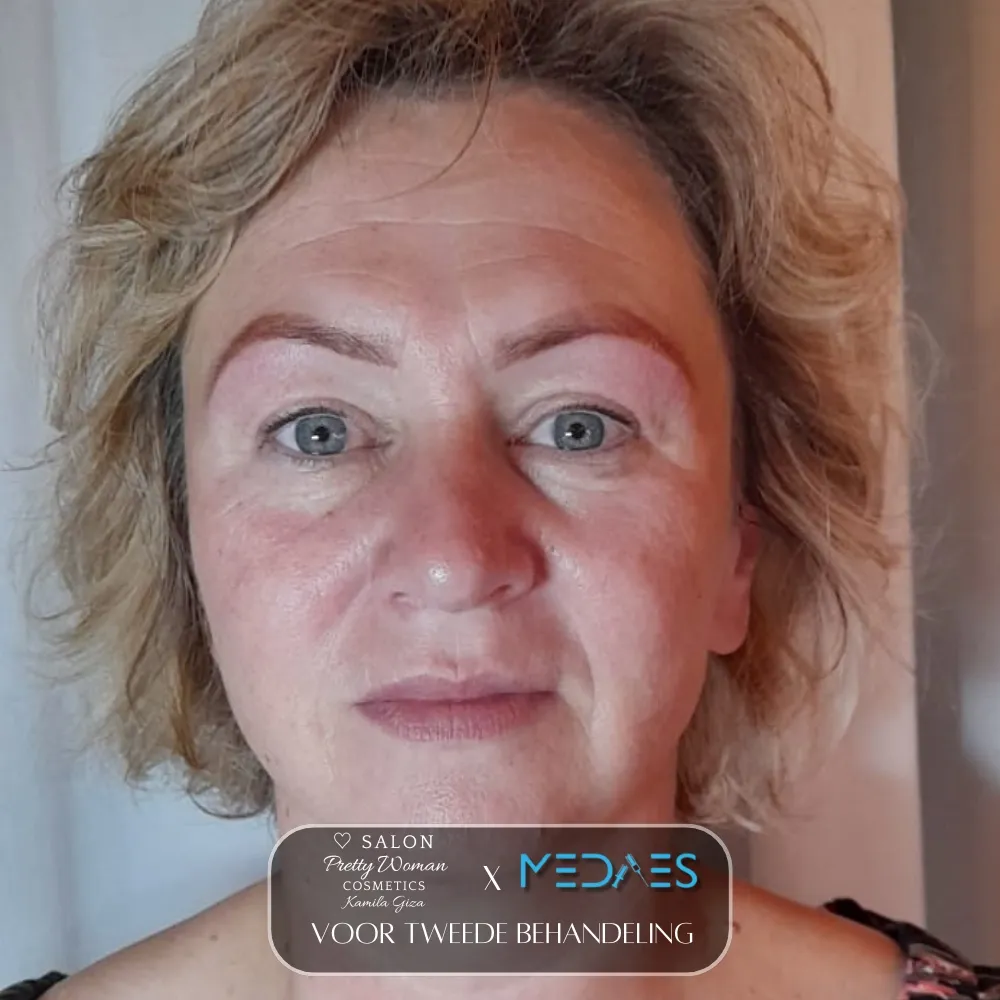 resultaten gezicht lifting met BioPen T6-SALON PRETTY WOMAN-M05-voor tweede behandeling-03