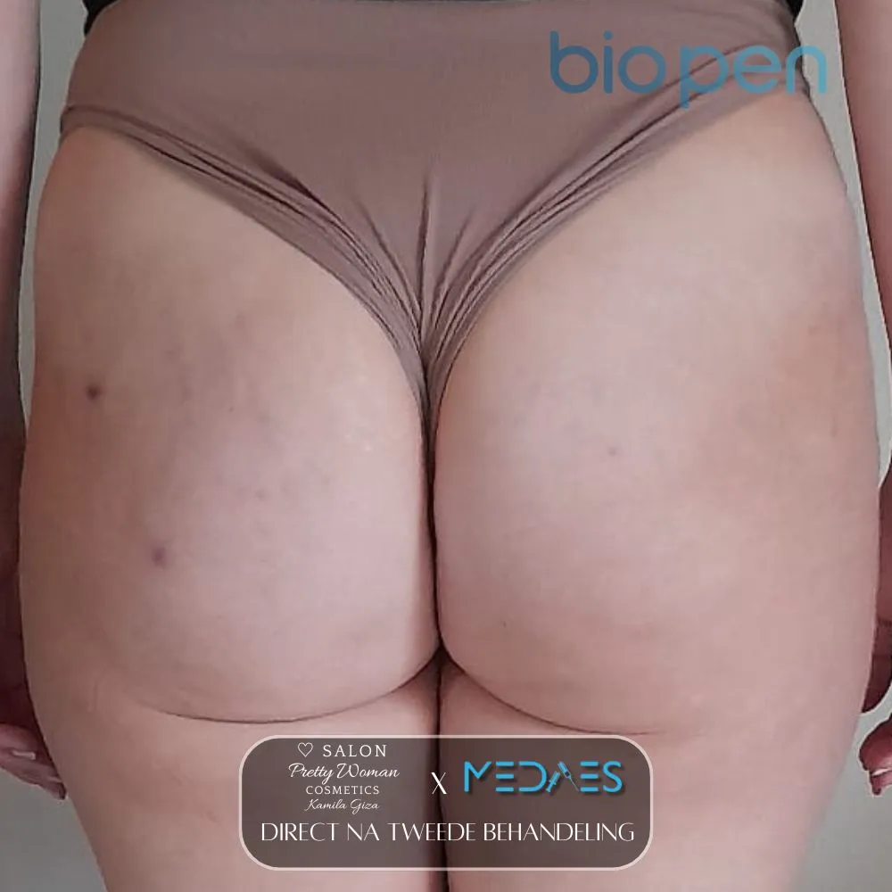 resultaten billen lifting met BioPen T6-SALON PRETTY WOMAN-M08-direct na tweede behandeling-05