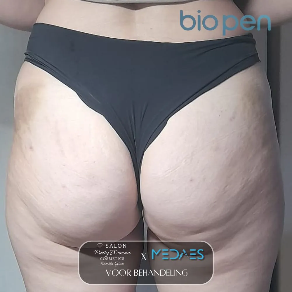 resultaten billen lifting met BioPen T6-SALON PRETTY WOMAN-M08-voor behandeling-01