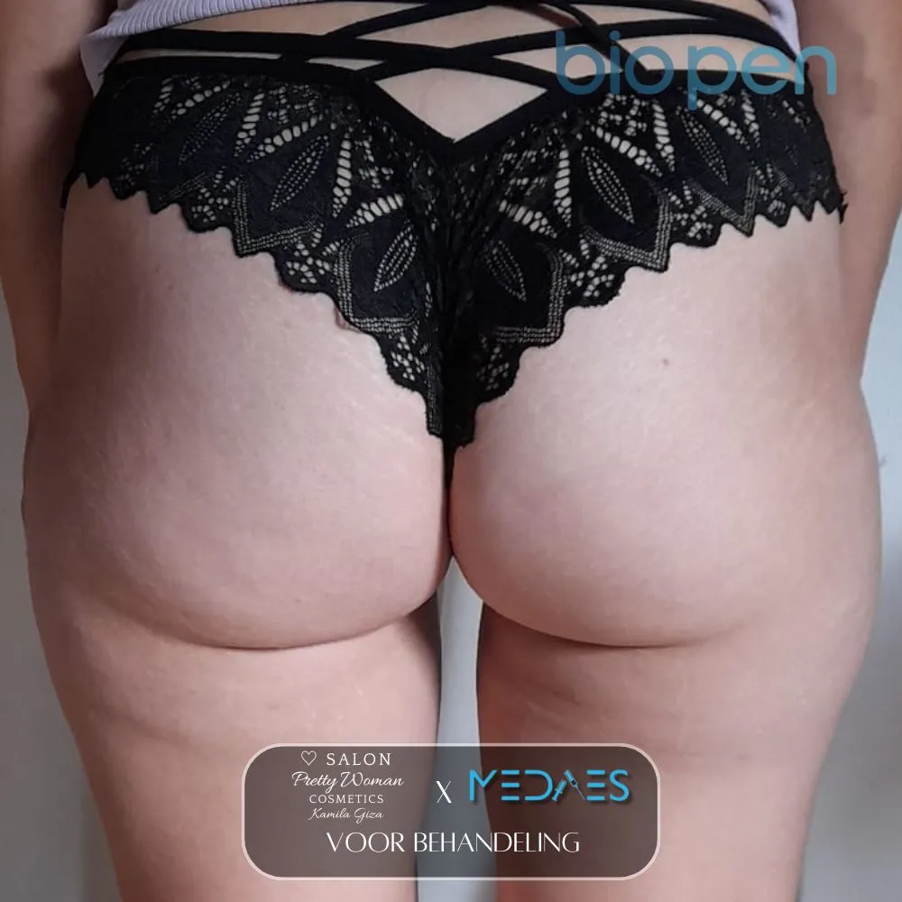 resultaten billen lifting met BioPen T6-SALON PRETTY WOMAN-M09-voor behandeling-01 (2)