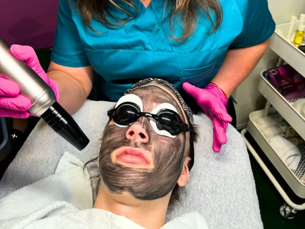 Carbon Laser behandeling met MA506A Picosecond laser tijdens anti-acne behandeling