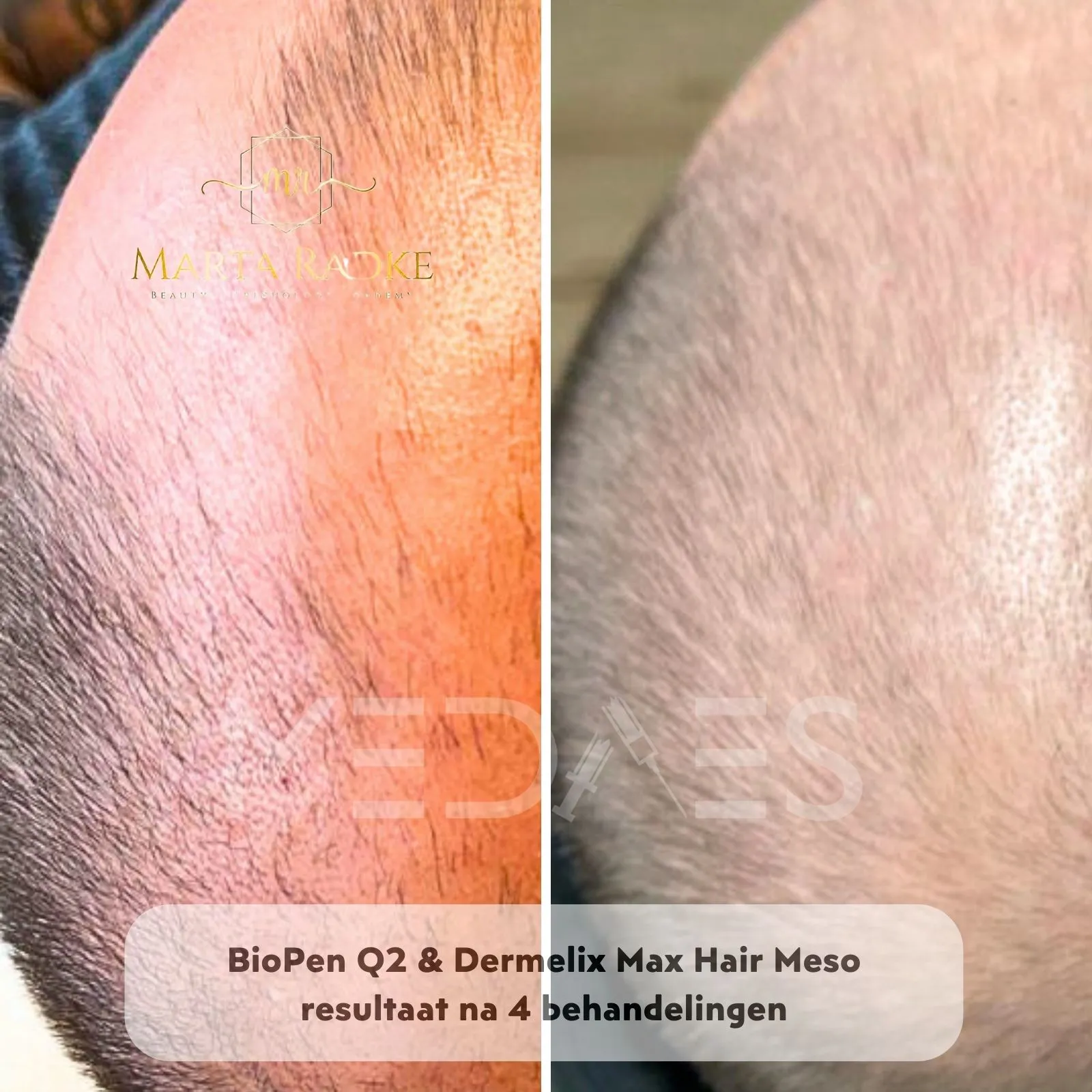 _Resultaten-microneedling met BioPen Q2 en Dermelix Max Hair Meso - Marta Radke-M02-voor en na 4 behandelingen-01