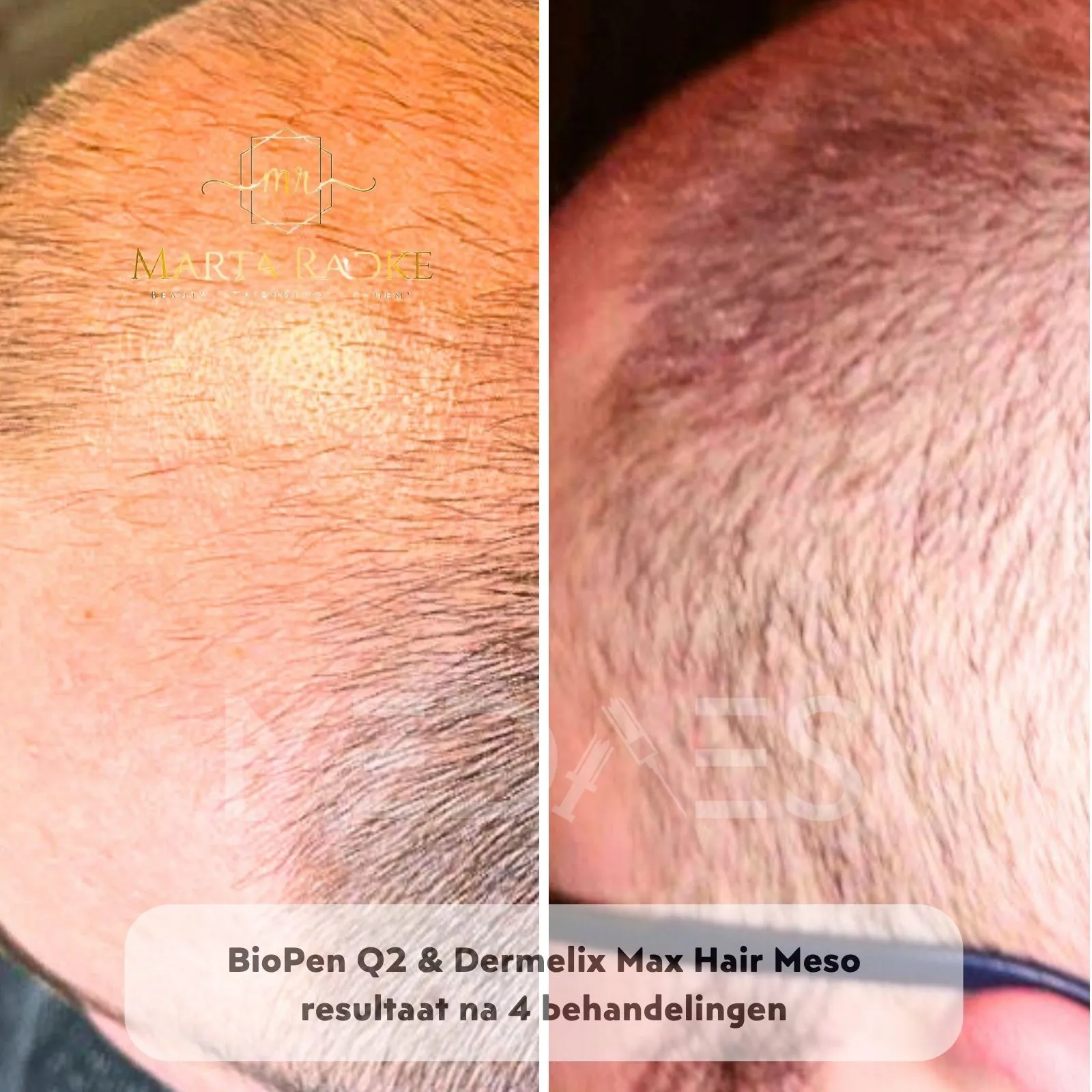 _Resultaten-microneedling met BioPen Q2 en Dermelix Max Hair Meso - Marta Radke-M02-voor en na 4 behandelingen-02