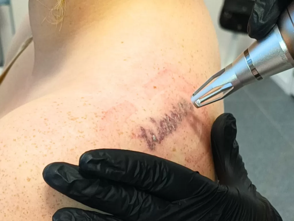 Tattoo verwijderen met MA506A Picosecond laser tijdens behandeling