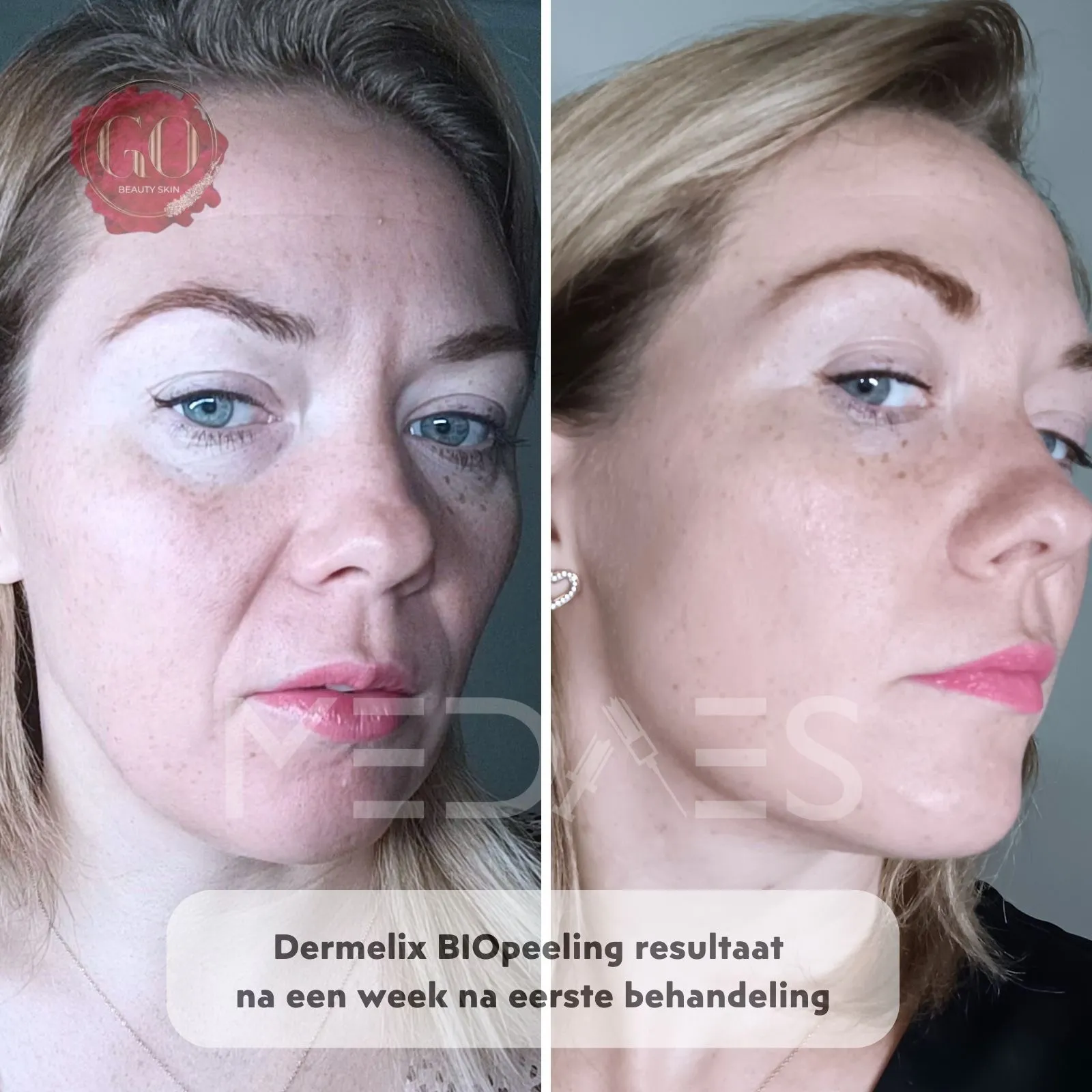 resultaten BioPeelig met Dermelix BP-002 – 60% PMPS Algen Peeling II (Bruin)-Beauty Skin Go-M01-voor en na 1 week na eerste behandeling-01