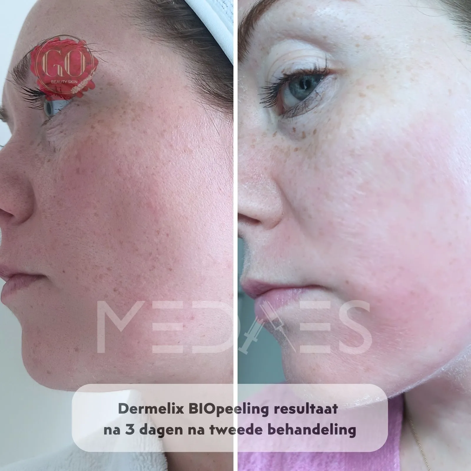 resultaten BioPeelig met Dermelix BP-002 – 60% PMPS Algen Peeling II (Bruin)-Beauty Skin Go-M01-voor en na 3 dagen na tweede behandeling-01