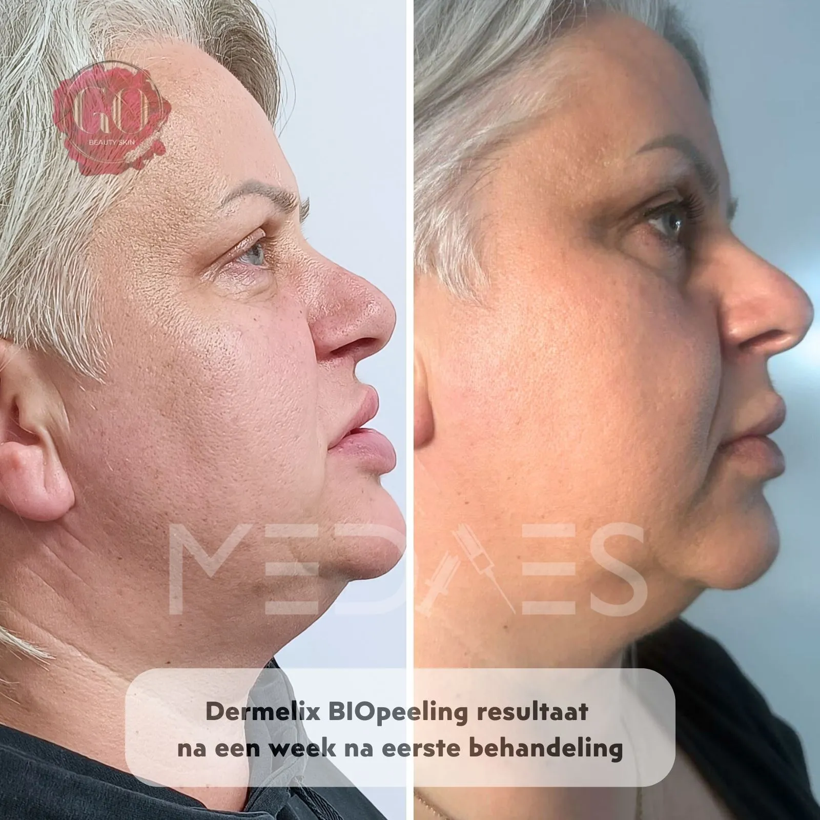 resultaten BioPeelig met Dermelix BP-002 – 60% PMPS Algen Peeling II (Bruin)-Beauty Skin Go-M02-voor en na 1 week na eerste behandeling-01
