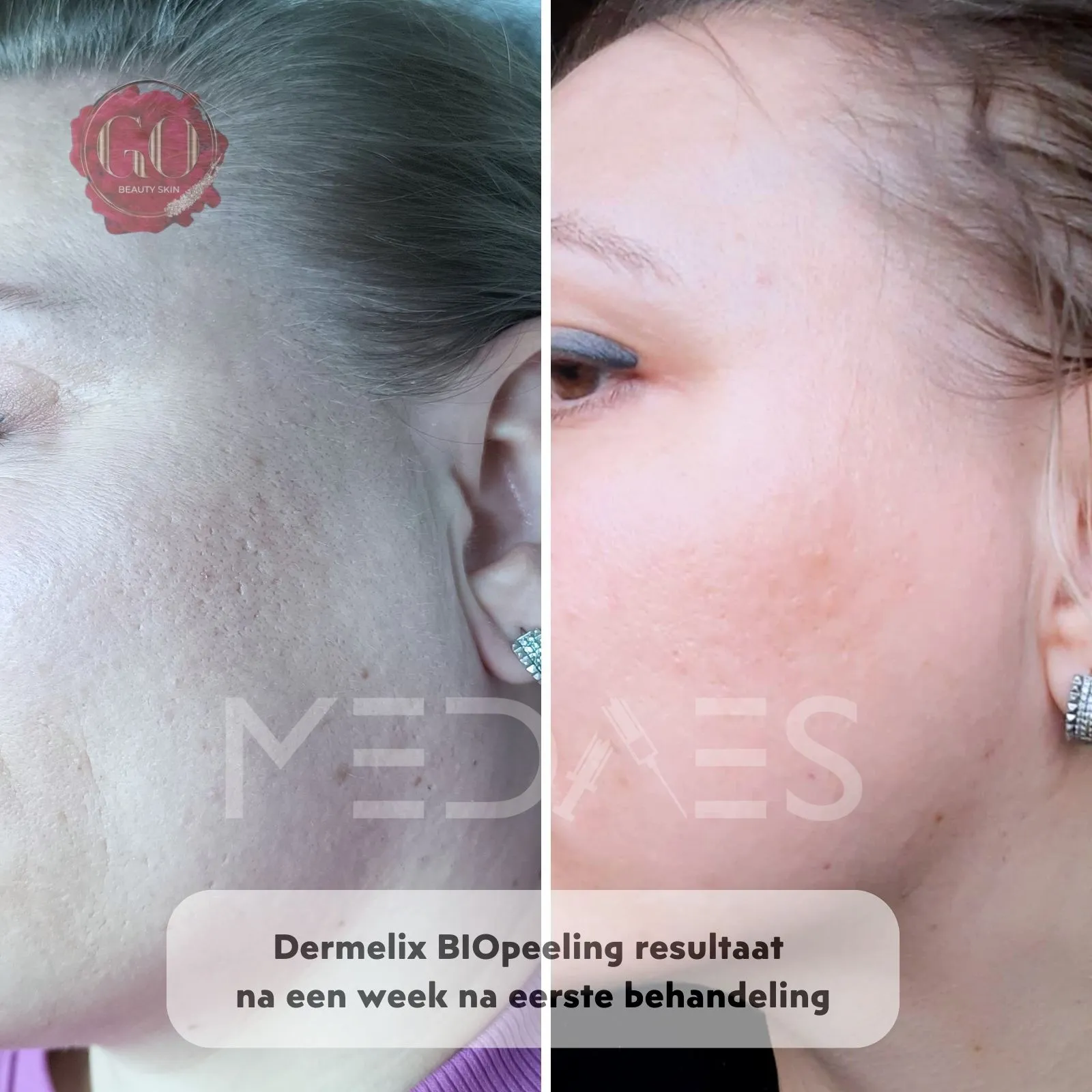 resultaten BioPeelig met Dermelix BP-002 – 60% PMPS Algen Peeling II (Bruin)-Beauty Skin Go-M03-voor en na 1 week na eerste behandeling-01