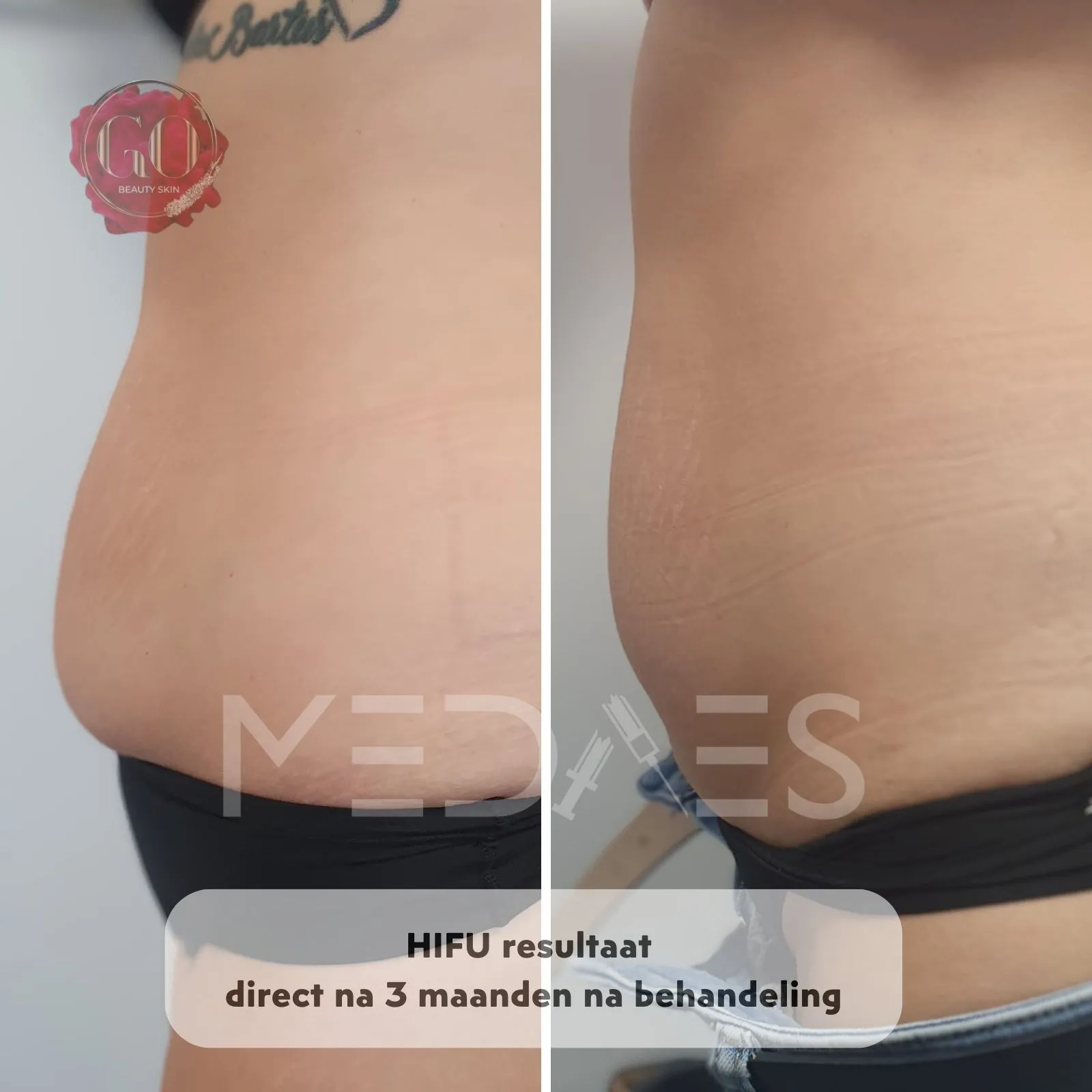 resultaten HIFU met MedAes HIFU 7D-Beauty Skin Go-M01-voor en na 3 maanden na behandeling-01