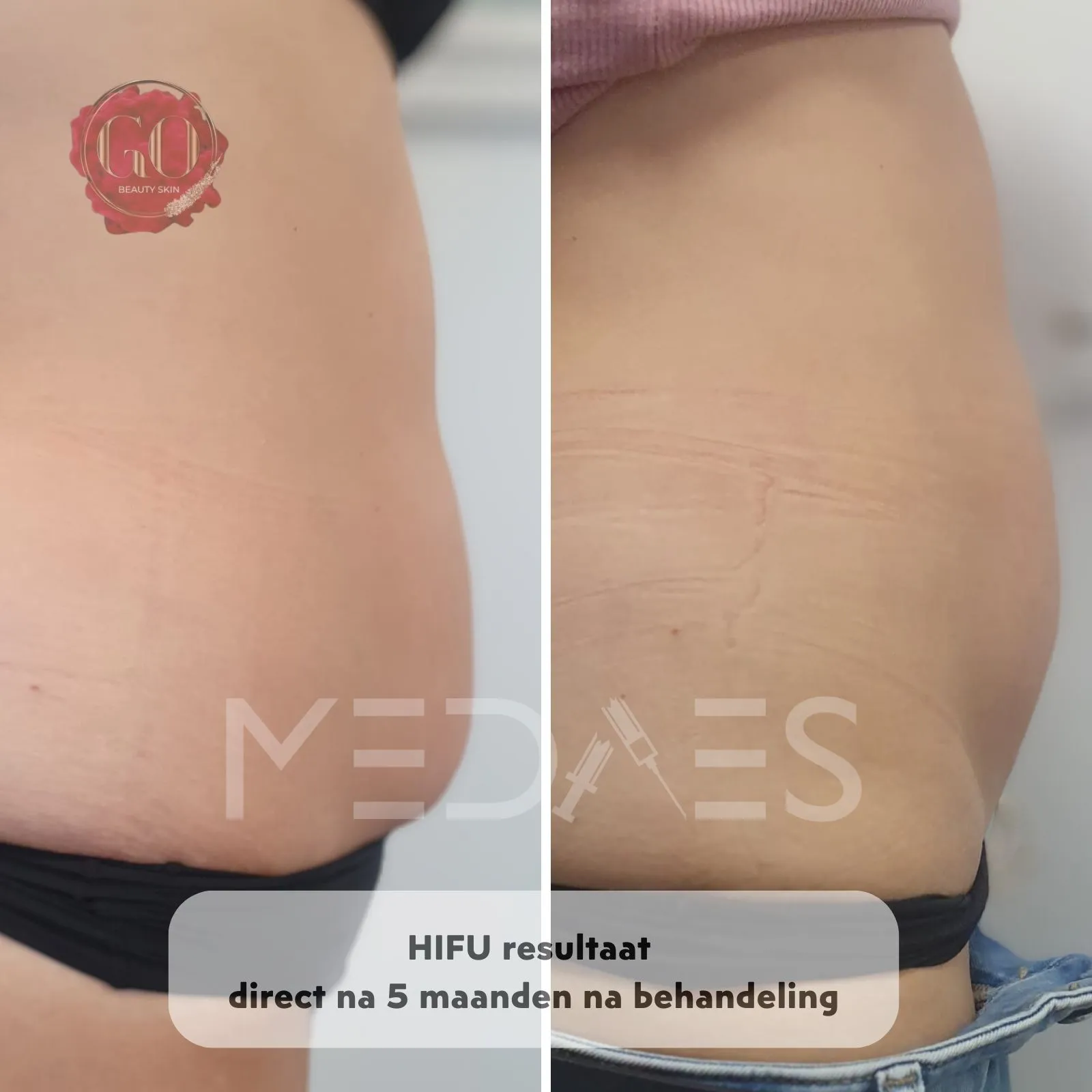 resultaten HIFU met MedAes HIFU 7D-Beauty Skin Go-M01-voor en na 3 maanden na behandeling-02
