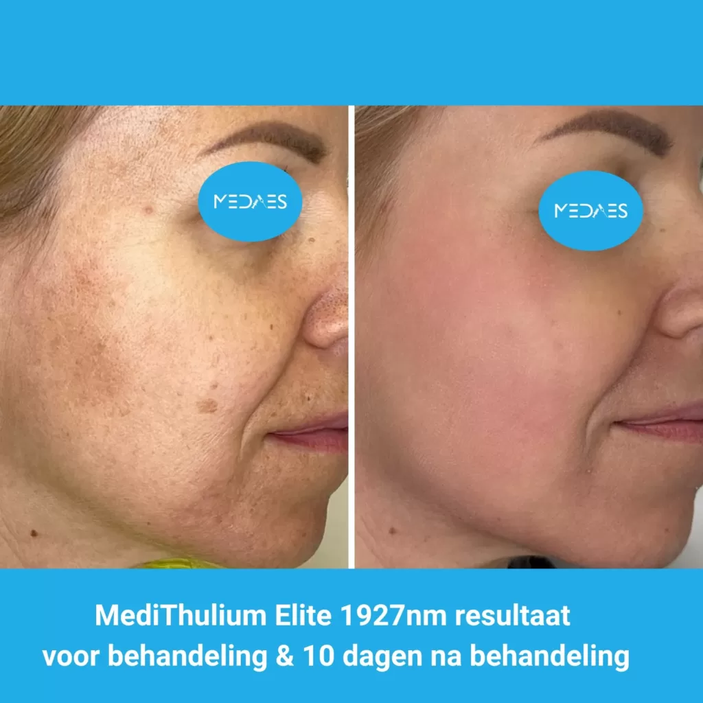 MediThulium Elite 1927nm van MedAes Europe resultaat voor behandeling & 10 dagen na behandeling melasma behandeling foto 2