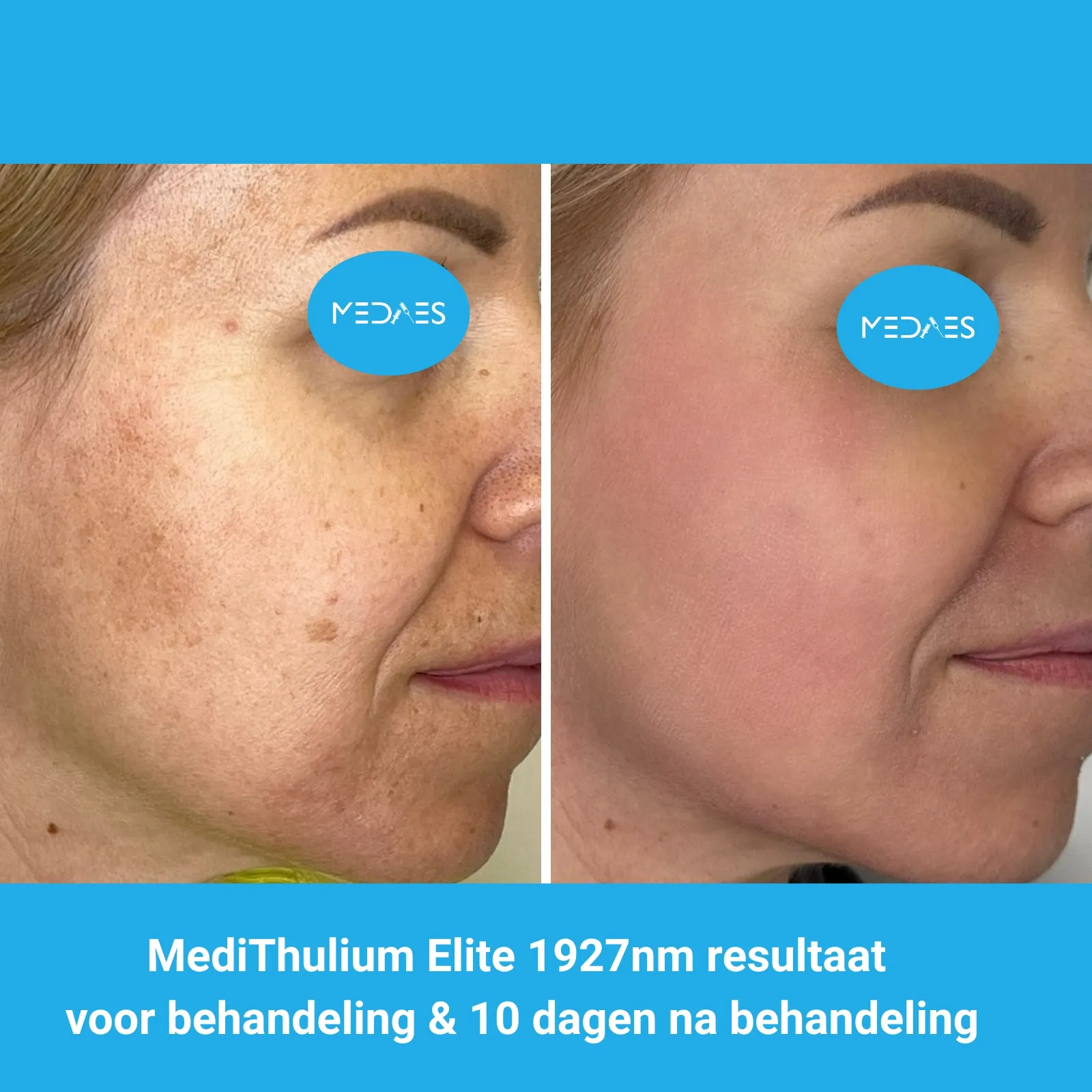 MediThulium Elite 1927nm van MedAes Europe resultaat voor behandeling & 10 dagen na behandeling melasma behandeling foto 2 MediThulium Elite 1927nm van MedAes Europe resultaat voor behandeling & 10 dagen na behandeling melasma behandeling foto 2