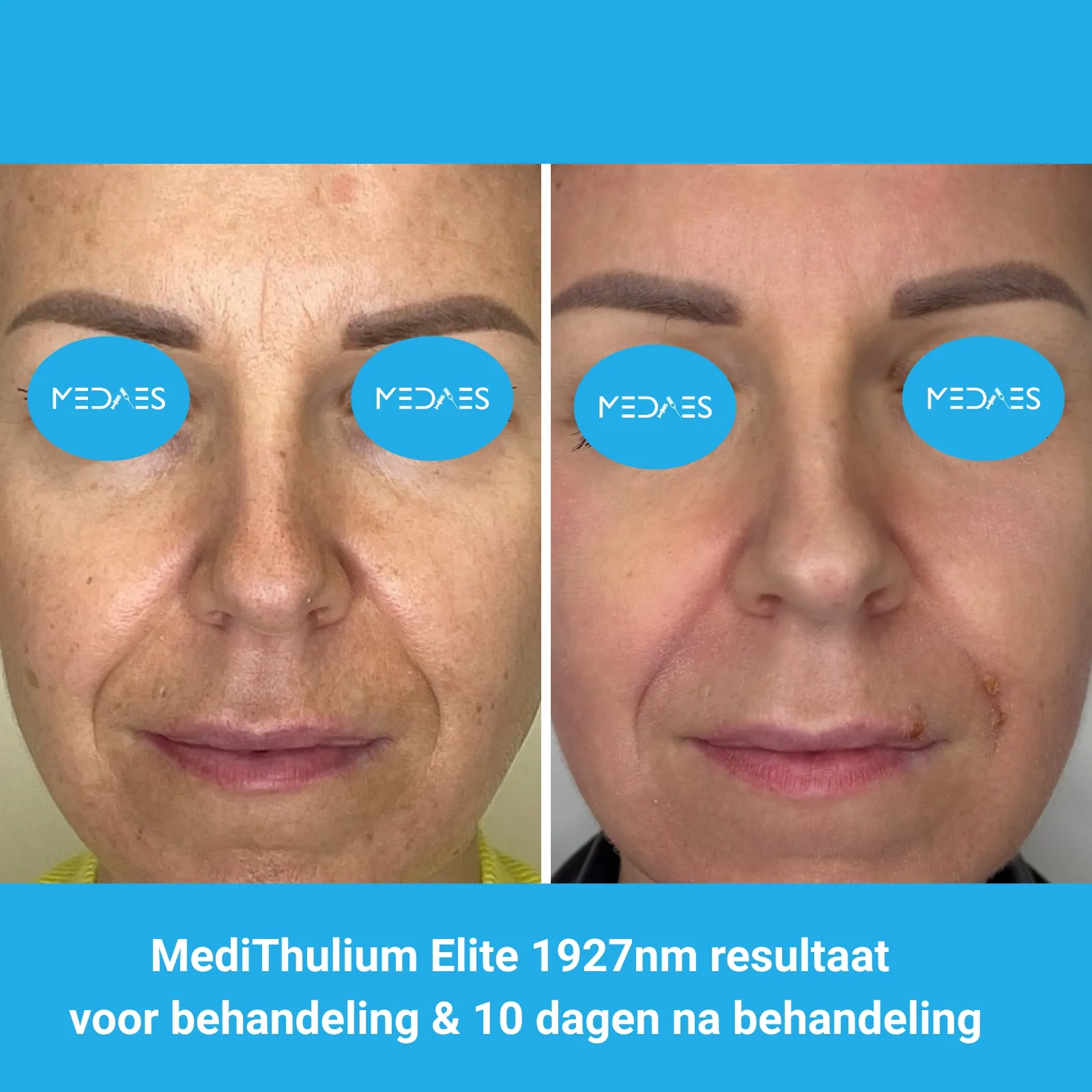 MediThulium Elite 1927nm van MedAes Europe resultaat voor behandeling & 10 dagen na behandeling melasma behandeling MediThulium Elite 1927nm van MedAes Europe resultaat voor behandeling & 10 dagen na behandeling melasma behandeling