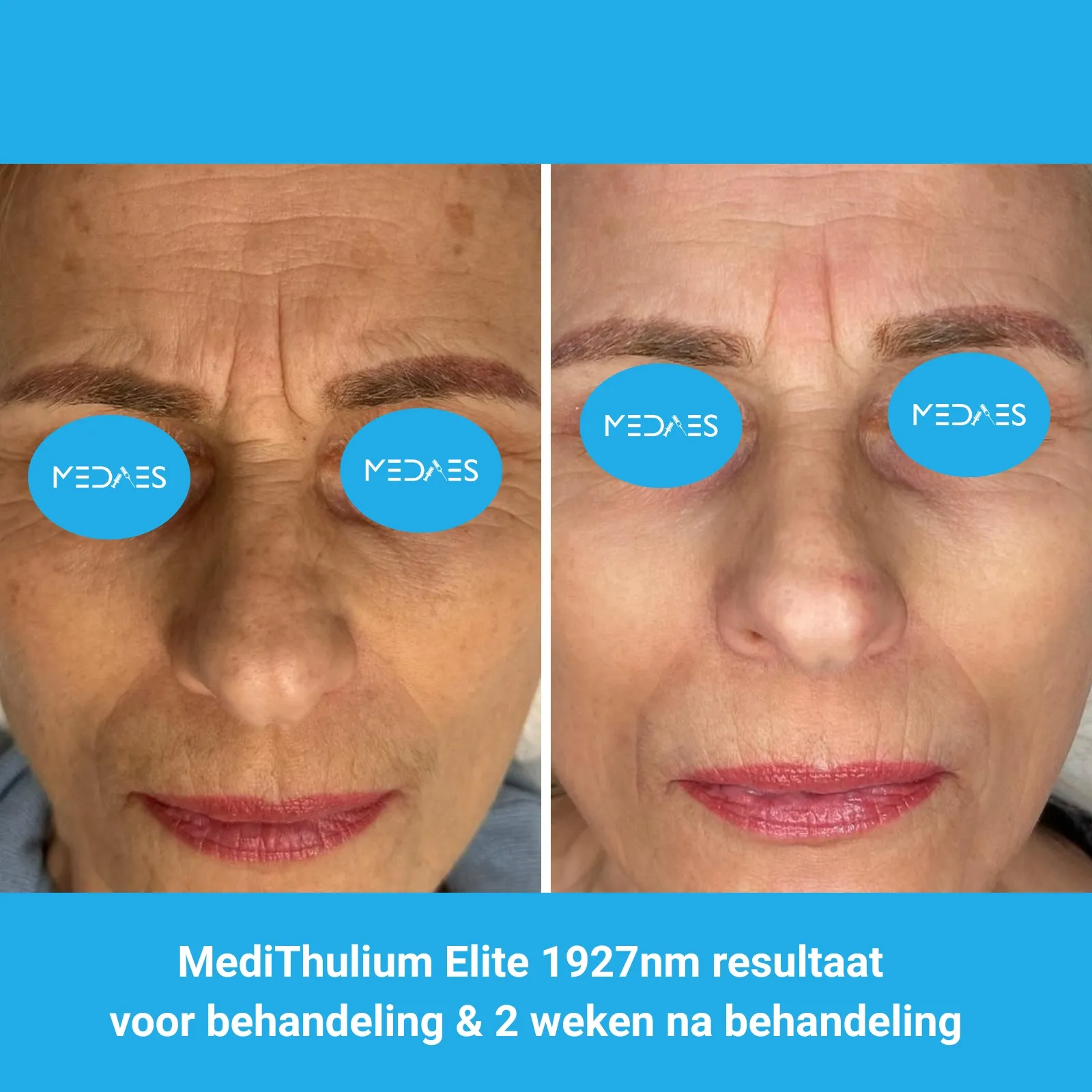 MediThulium Elite 1927nm van MedAes Europe resultaat voor behandeling & 2 weken na behandeling gezicht rejuvenation foto 2 MediThulium Elite 1927nm van MedAes Europe resultaat voor behandeling & 2 weken na behandeling gezicht rejuvenation foto 2