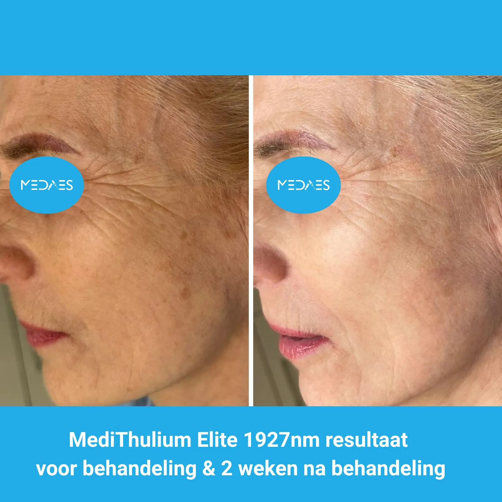 MediThulium Elite 1927nm van MedAes Europe resultaat voor behandeling & 2 weken na behandeling gezicht rejuvenation MediThulium Elite 1927nm van MedAes Europe resultaat voor behandeling & 2 weken na behandeling gezicht rejuvenation