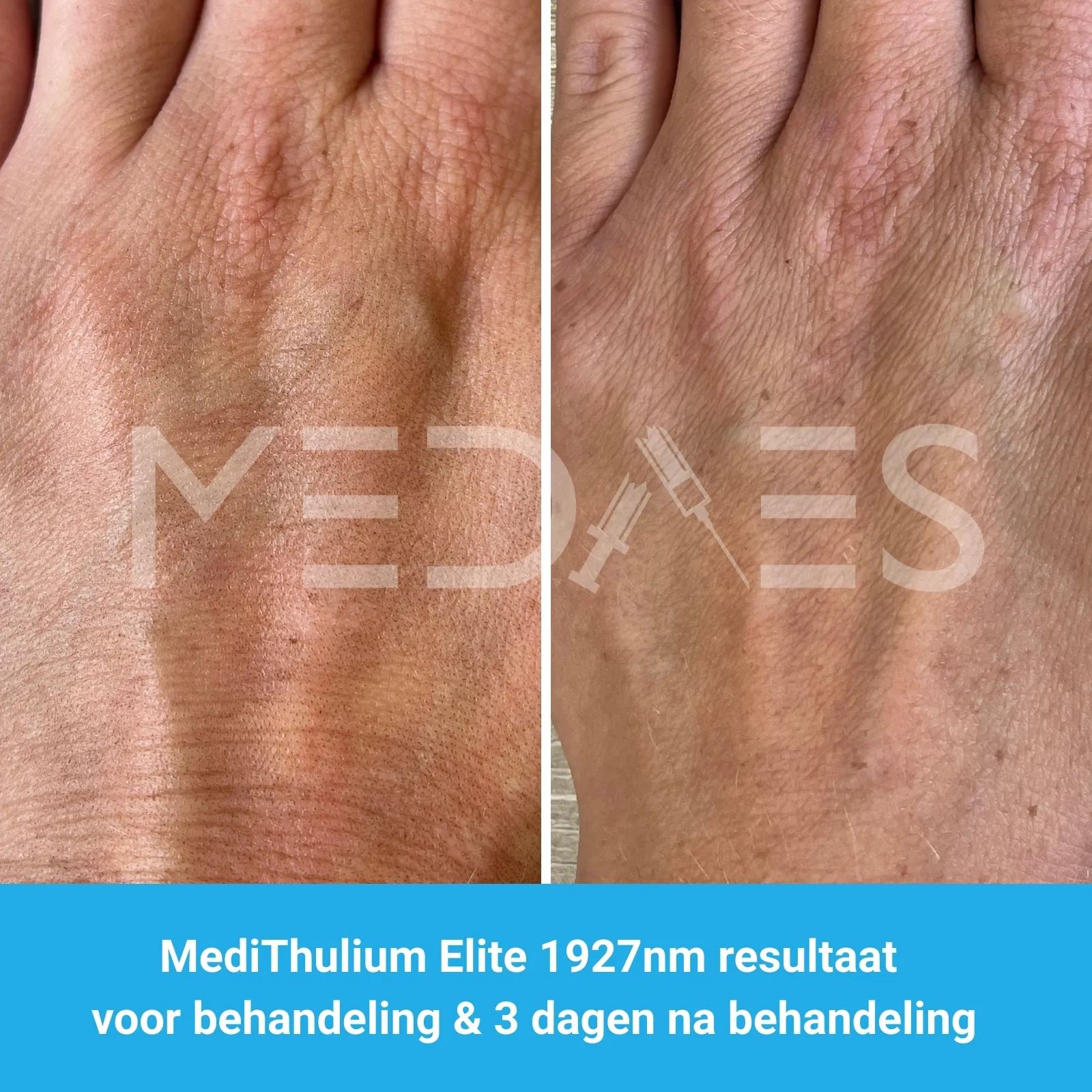MediThulium Elite 1927nm van MedAes Europe resultaat voor behandeling & 3 dagen na behandeling hand rejuvenation foto 2 MediThulium Elite 1927nm van MedAes Europe resultaat voor behandeling & 3 dagen na behandeling hand rejuvenation foto 2