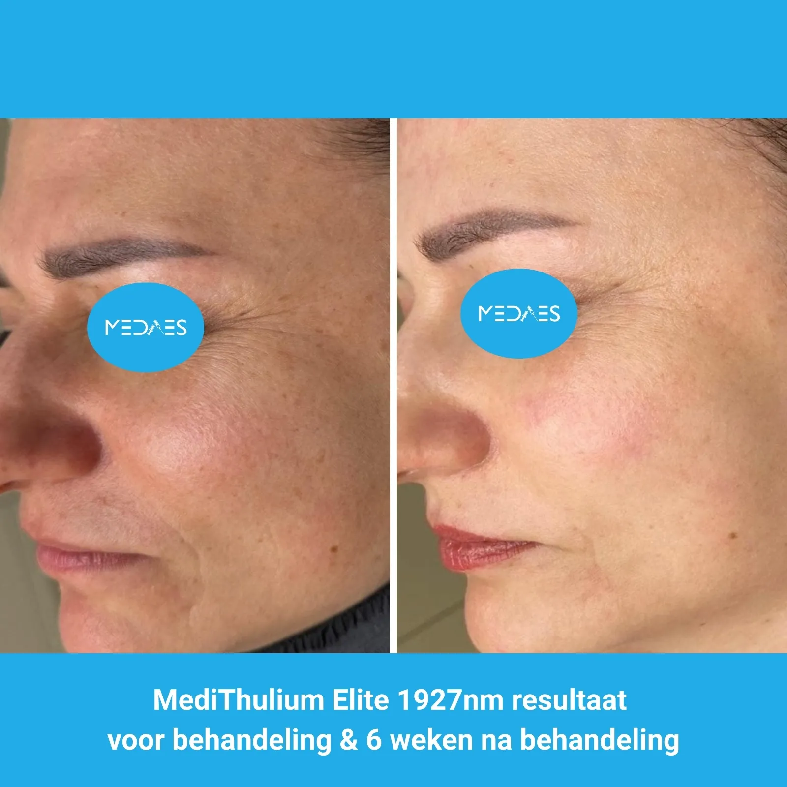 MediThulium Elite 1927nm van MedAes Europe resultaat voor behandeling & 6 weken na behandeling gezicht rejuvenation foto 2 MediThulium Elite 1927nm van MedAes Europe resultaat voor behandeling & 6 weken na behandeling gezicht rejuvenation foto 2