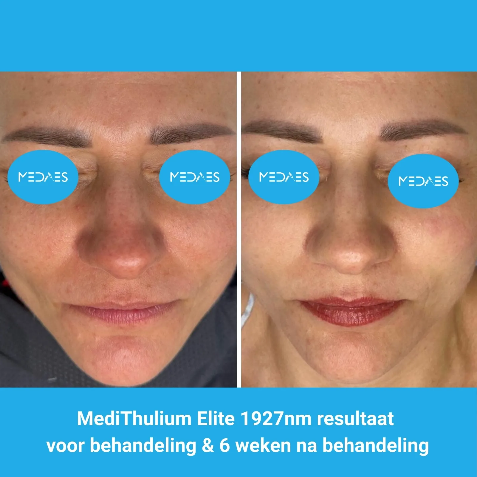 MediThulium Elite 1927nm van MedAes Europe resultaat voor behandeling & 6 weken na behandeling gezicht rejuvenation MediThulium Elite 1927nm van MedAes Europe resultaat voor behandeling & 6 weken na behandeling gezicht rejuvenation