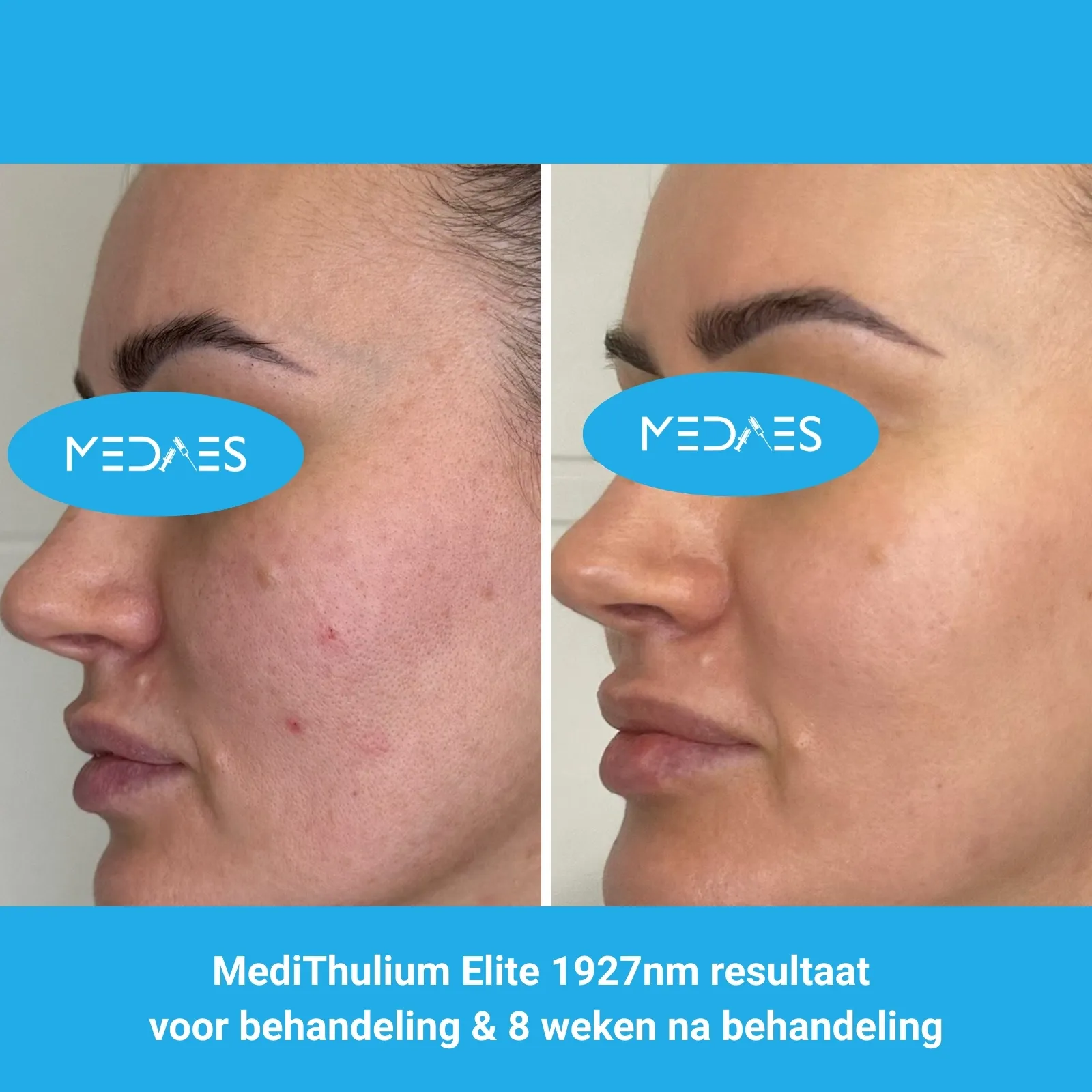 MediThulium Elite 1927nm van MedAesresultaat voor behandeling & 8 weken na behandeling MediThulium Elite 1927nm van MedAesresultaat voor behandeling & 8 weken na behandeling