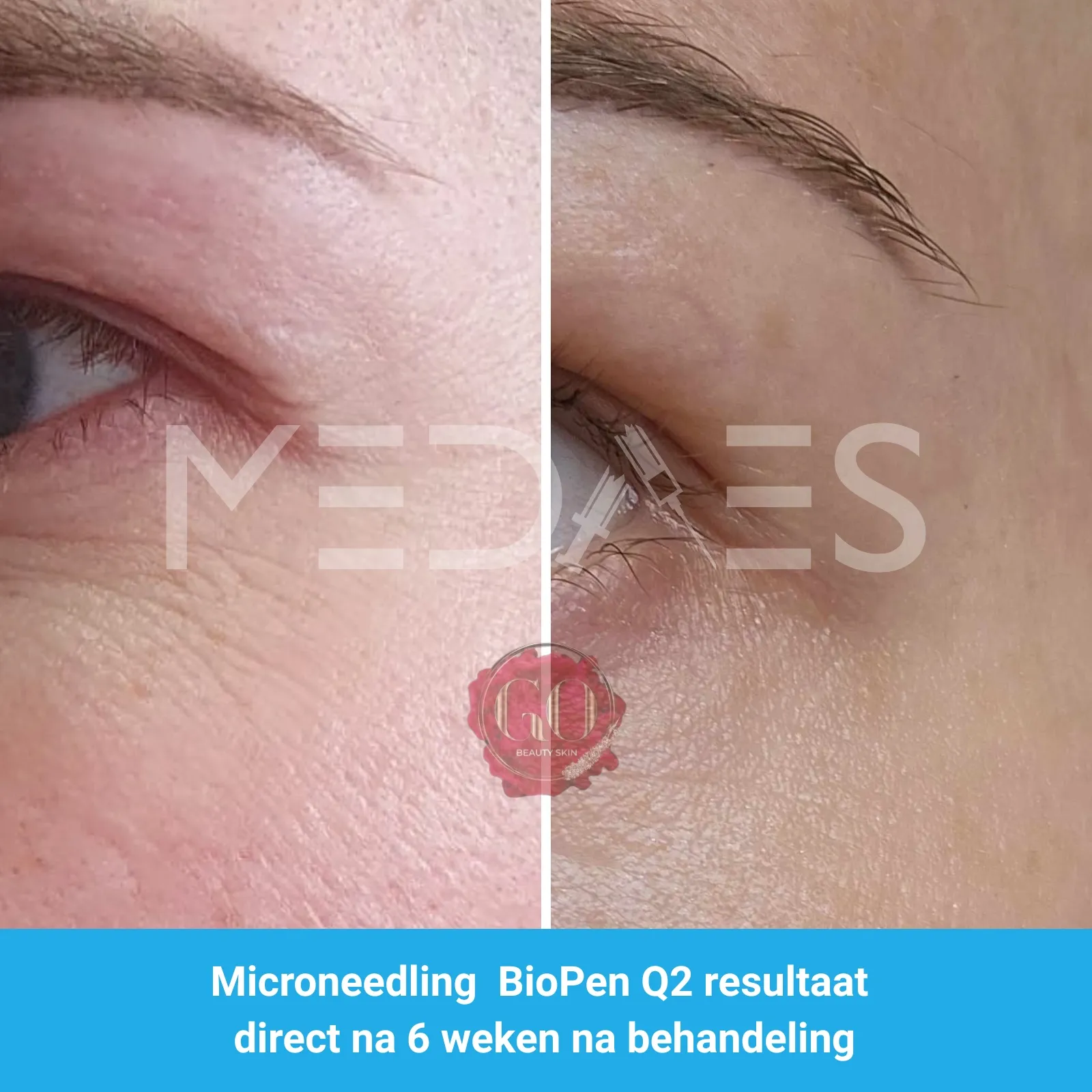 Resultaten-microneedling met BioPen Q2 -Beauty Skin Go-M01-voor en na 6 weken na behandeling-01