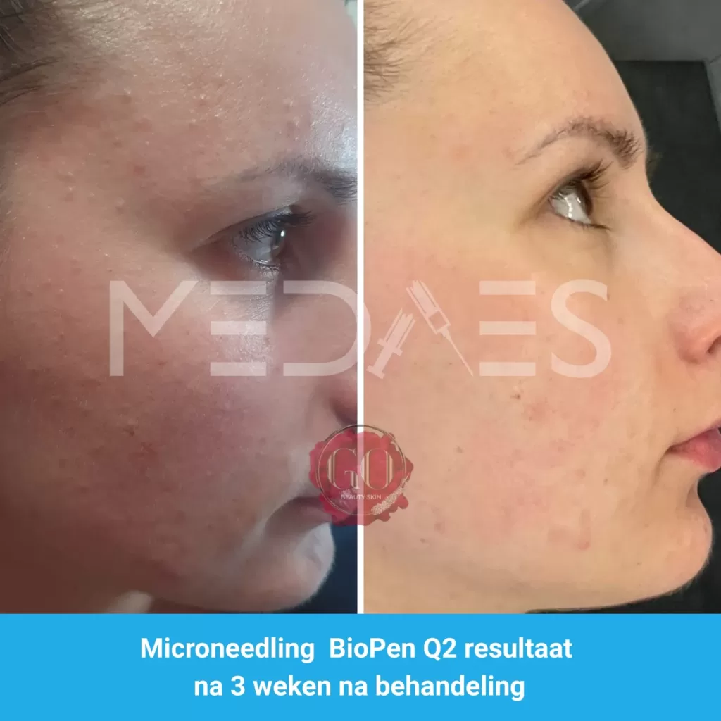 Resultaten-microneedling met BioPen Q2 -Beauty Skin Go-M04-voor en na 3 weken na behandeling-01 Resultaten-microneedling met BioPen Q2 -Beauty Skin Go-M04-voor en na 3 weken na behandeling-01