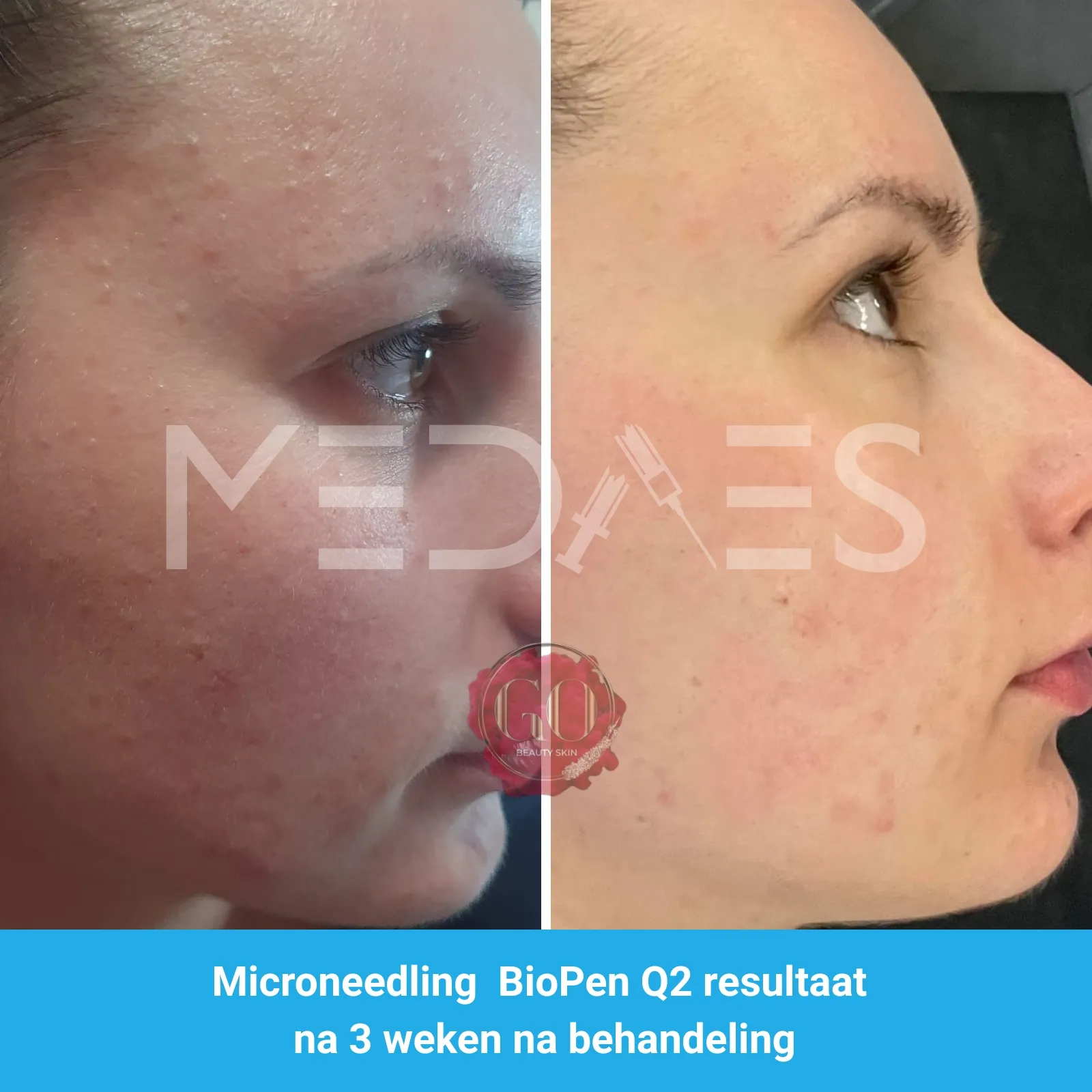 Resultaten-microneedling met BioPen Q2 -Beauty Skin Go-M04-voor en na 3 weken na behandeling-01