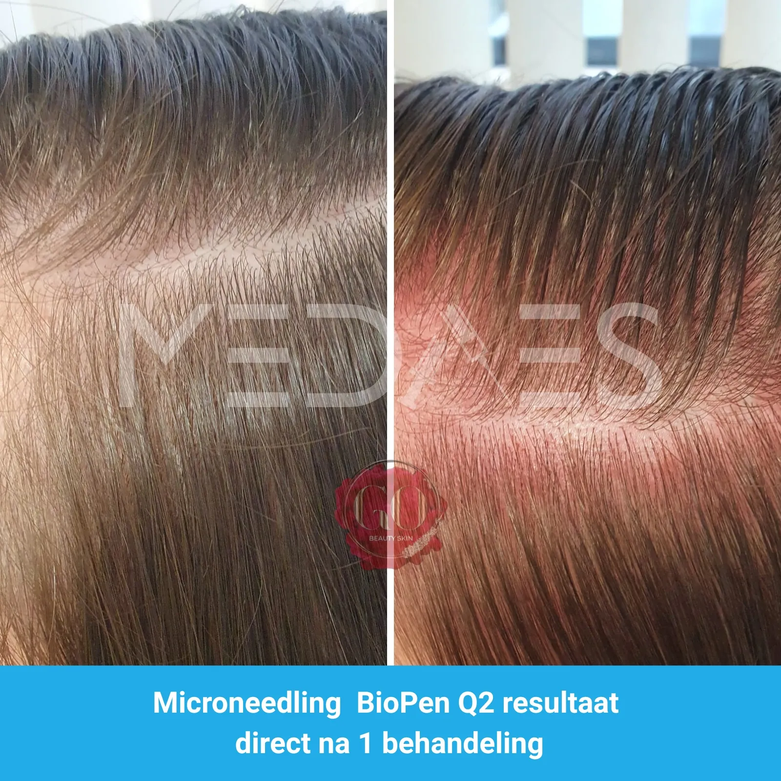 Resultaten-microneedling met BioPen Q2 en Dermelix Max Hair Meso -Beauty Skin Go-M02-voor en direct na behandeling-01