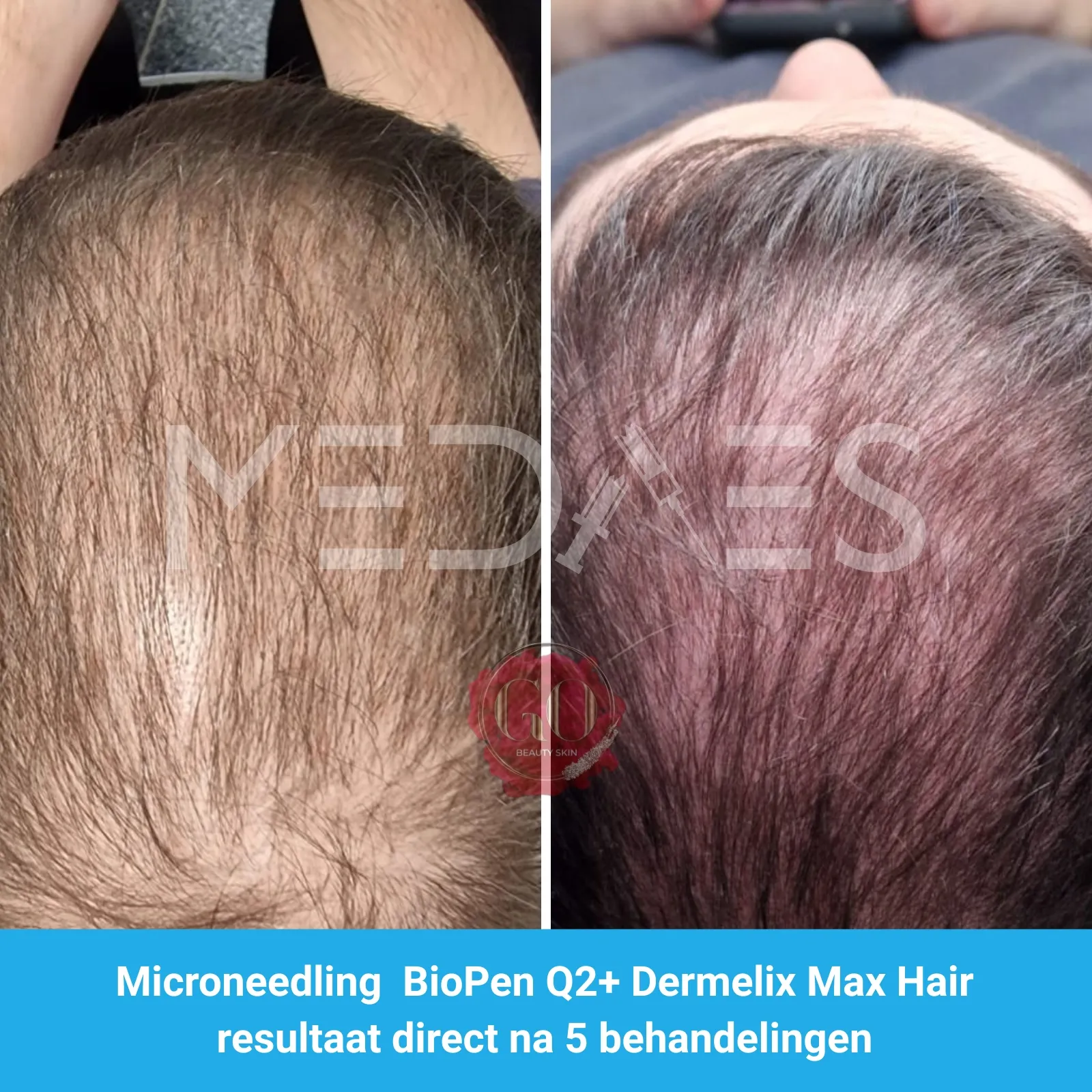 Resultaten-microneedling met BioPen Q2 en Dermelix Max Hair Meso -Beauty Skin Go-M03-voor en direct na behandeling-01