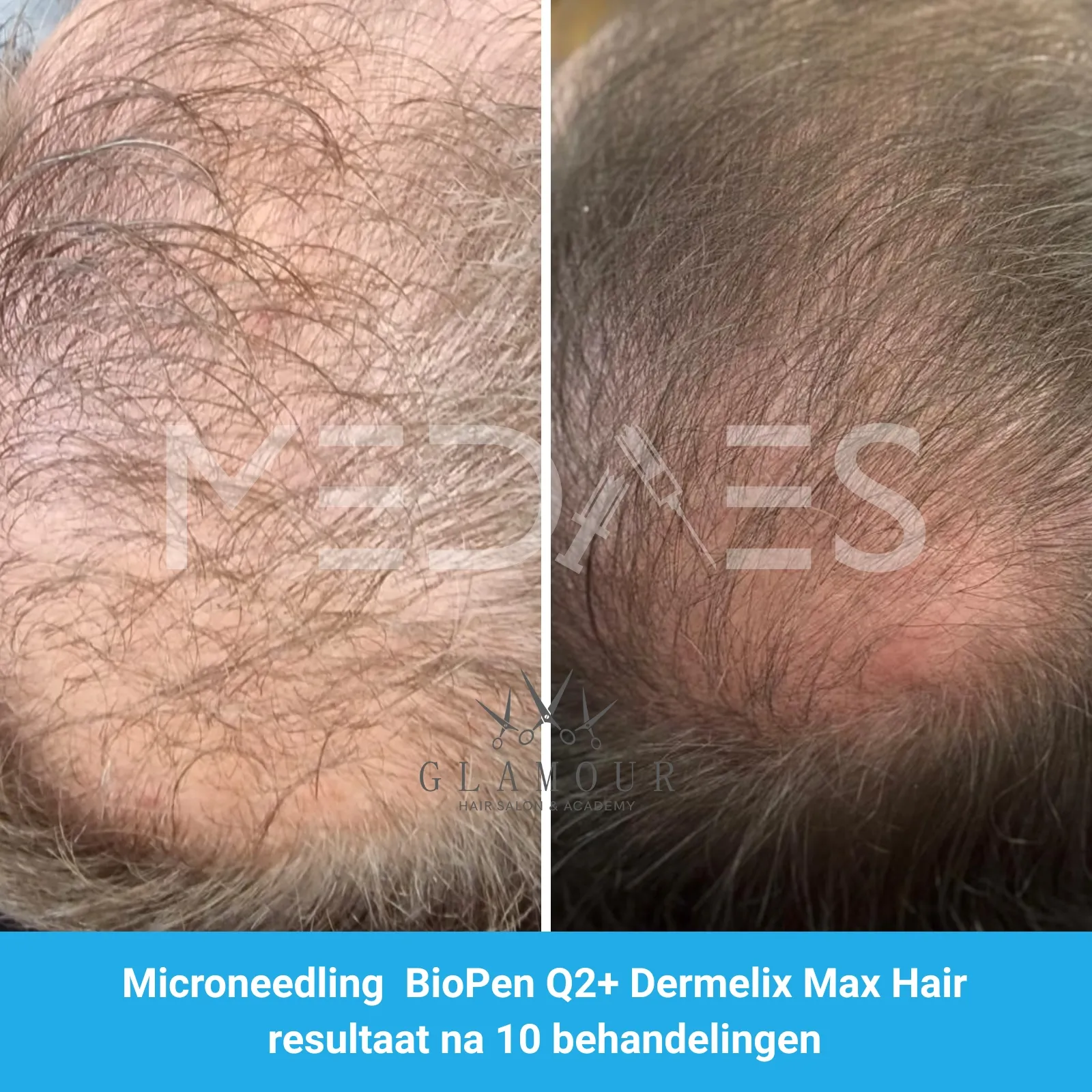 Resultaten-microneedling met BioPen Q2 en Dermelix Max Hair Meso -Glamour Hair salon & Academy-M01-voor en direct na behandeling-01