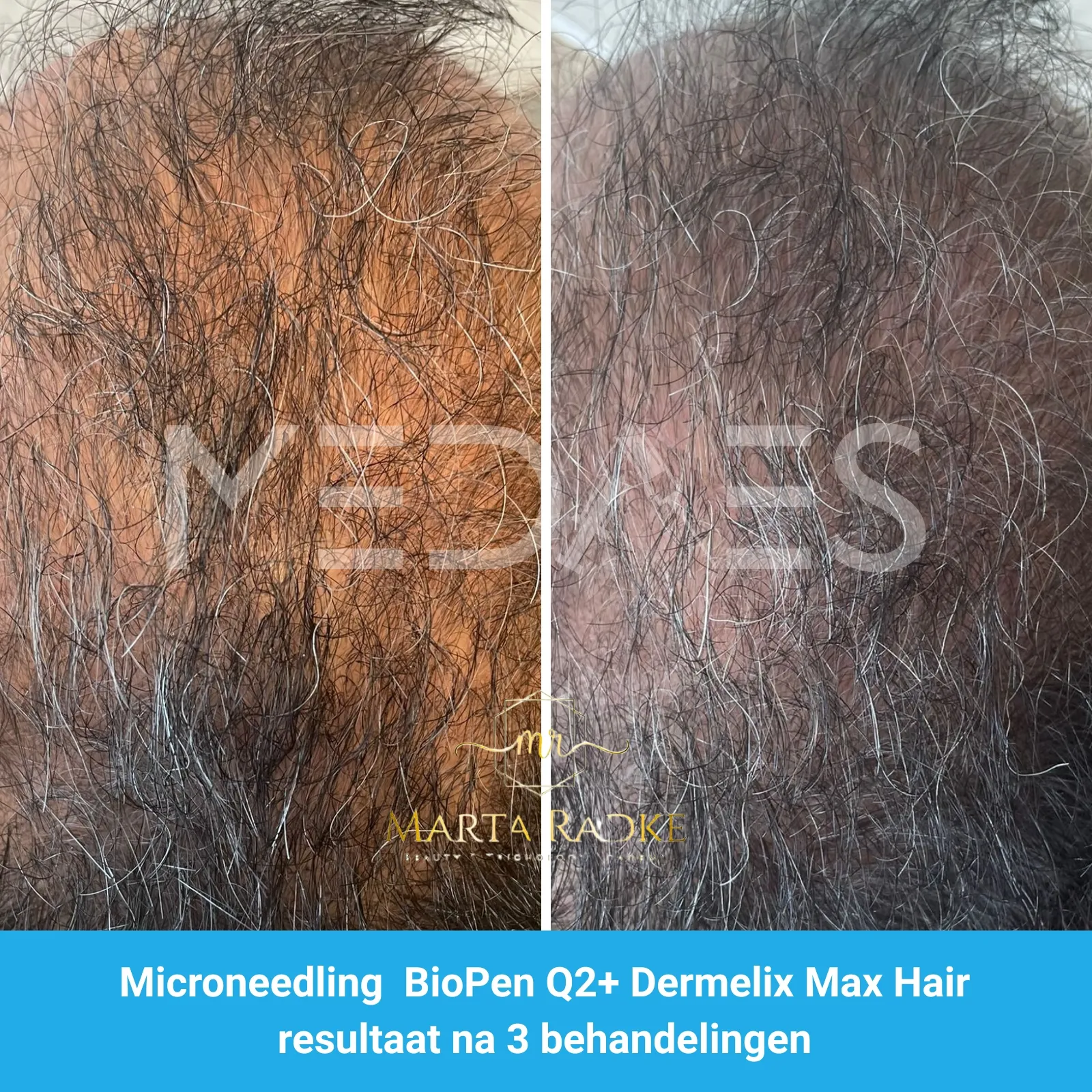 Resultaten-microneedling met BioPen Q2 en Dermelix Max Hair Meso – Marta Radke-M01-voor en direct na behandeling-01