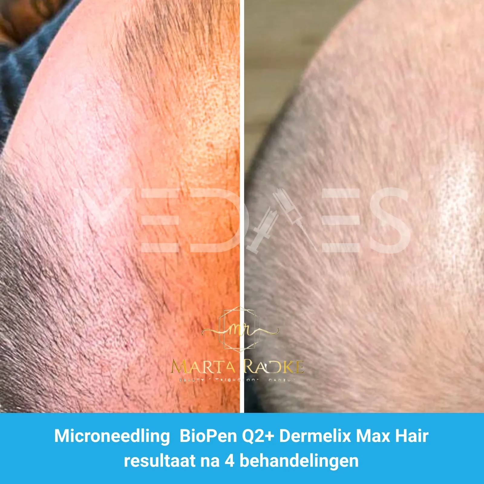 Resultaten-microneedling met BioPen Q2 en Dermelix Max Hair Meso – Marta Radke-M02-voor en na 4 behandelingen-01