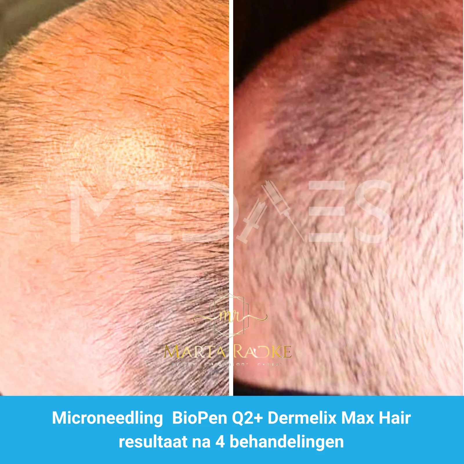 Resultaten-microneedling met BioPen Q2 en Dermelix Max Hair Meso – Marta Radke-M02-voor en na 4 behandelingen-02
