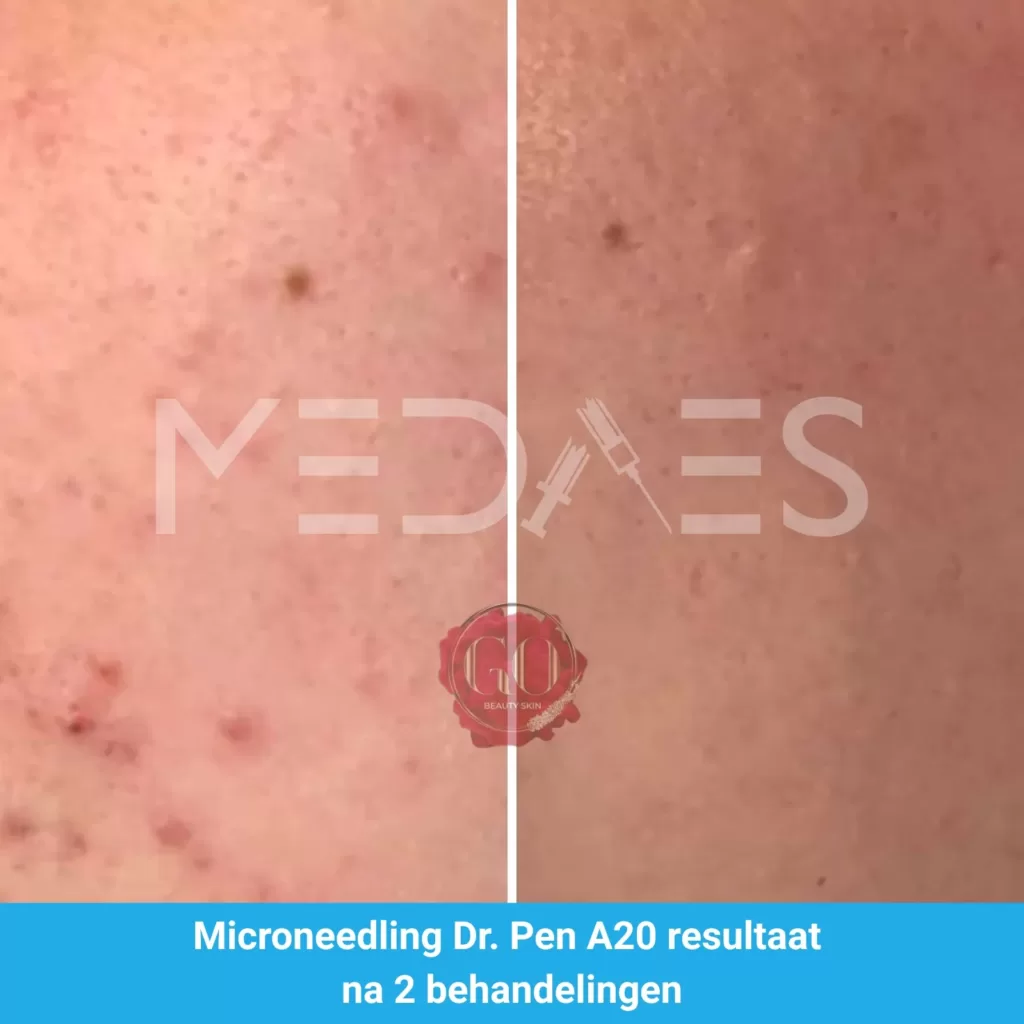 Resultaten-microneedling met Dr. Pen A20 -Beauty Skin Go-M05-voor en na 3 behandelingen-01 Resultaten-microneedling met Dr. Pen A20 -Beauty Skin Go-M05-voor en na 3 behandelingen-01