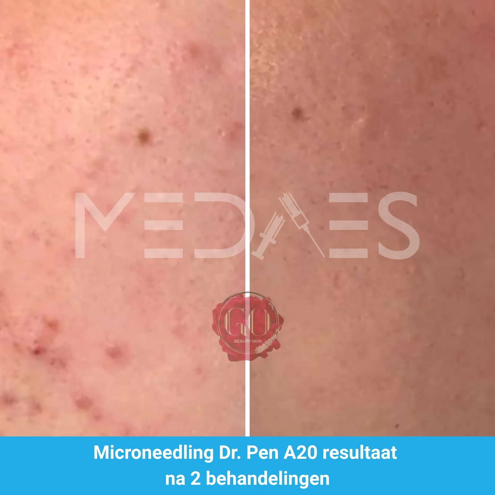 Resultaten-microneedling met Dr. Pen A20 -Beauty Skin Go-M05-voor en na 3 behandelingen-01