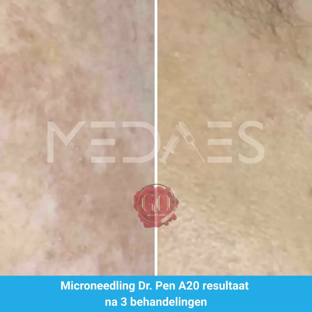 Resultaten-microneedling met Dr. Pen A20 -Beauty Skin Go-M06-voor en na 3 behandelingen-01 Resultaten-microneedling met Dr. Pen A20 -Beauty Skin Go-M06-voor en na 3 behandelingen-01