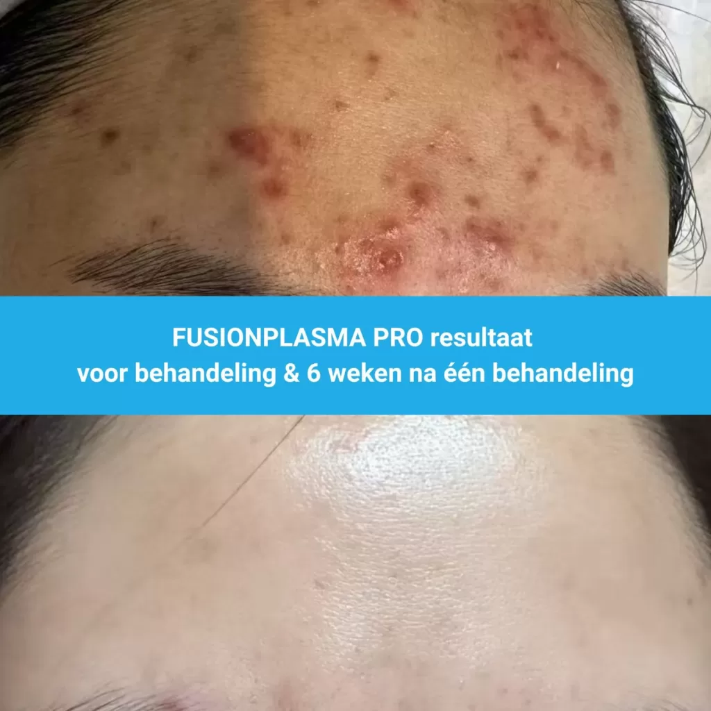 resultaat ACNE behandeling met FusionPlasma Pro van MedAes- M06 voor behandeling & 3 weken na tweede behandeling foto 2
