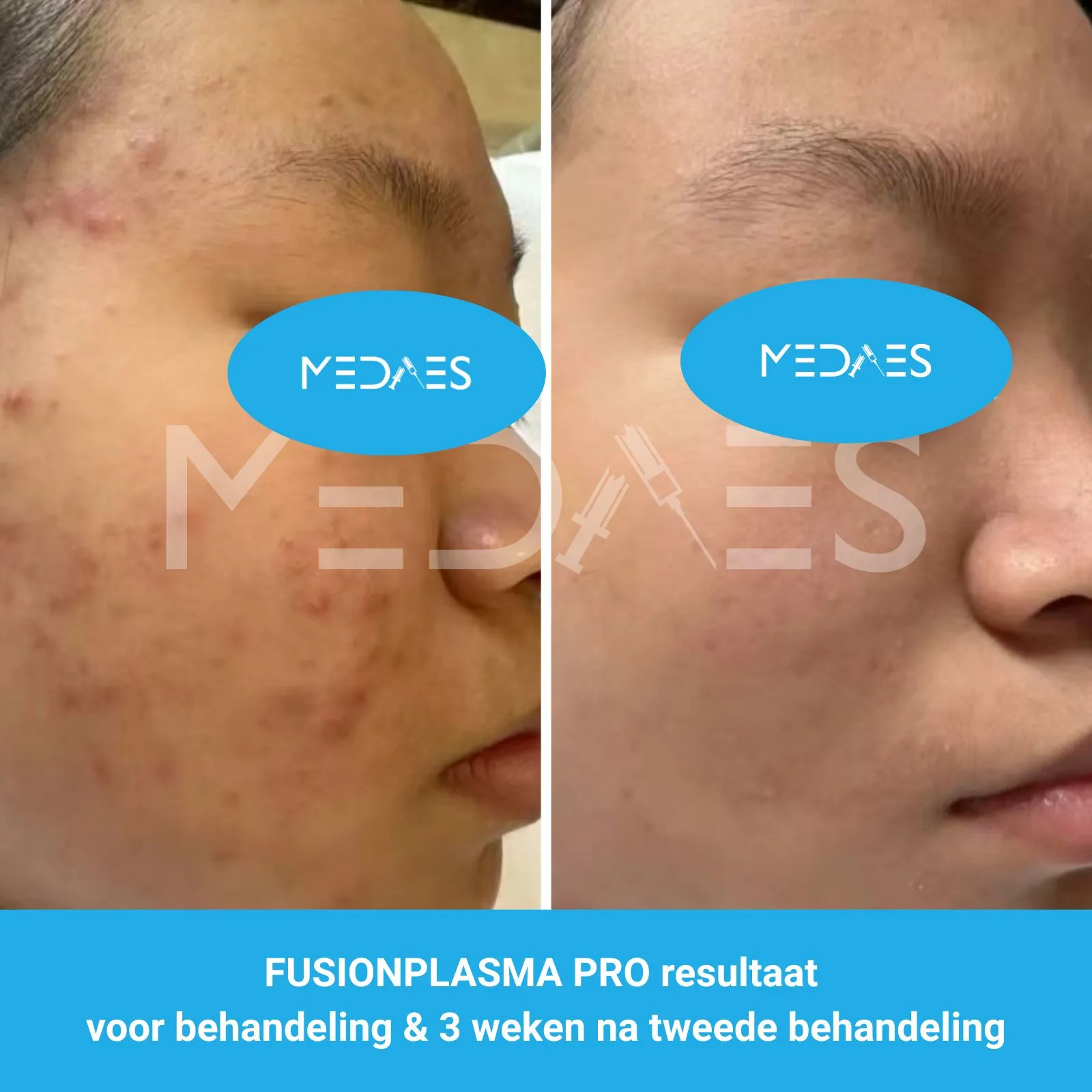 resultaat ACNE behandeling met FusionPlasma Pro van MedAes- M06 voor behandeling & 3 weken na tweede behandeling resultaat ACNE behandeling met FusionPlasma Pro van MedAes- M06 voor behandeling & 3 weken na tweede behandeling