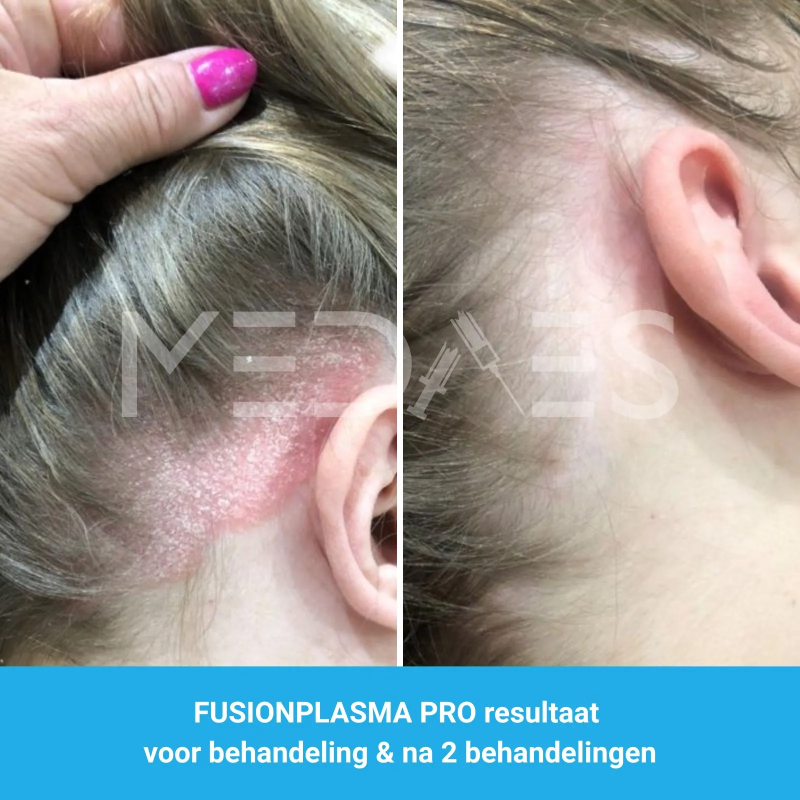 resultaat psoriasis capitis behandeling met FusionPlasma Pro van MedAes- M07 voor behandeling & na 2 behandelingen
