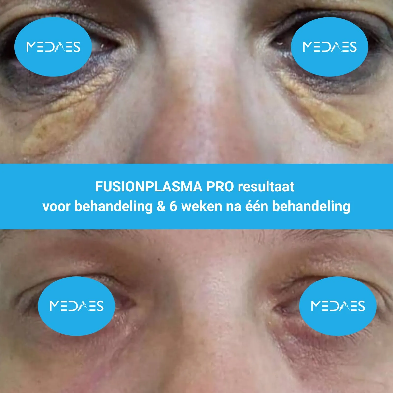 resultaat xanthelasma rond de ogen met FusionPlasma Pro van MedAes- M05- voor behandeling & 6 weken na één behandeling resultaat xanthelasma rond de ogen met FusionPlasma Pro van MedAes- M05- voor behandeling & 6 weken na één behandeling