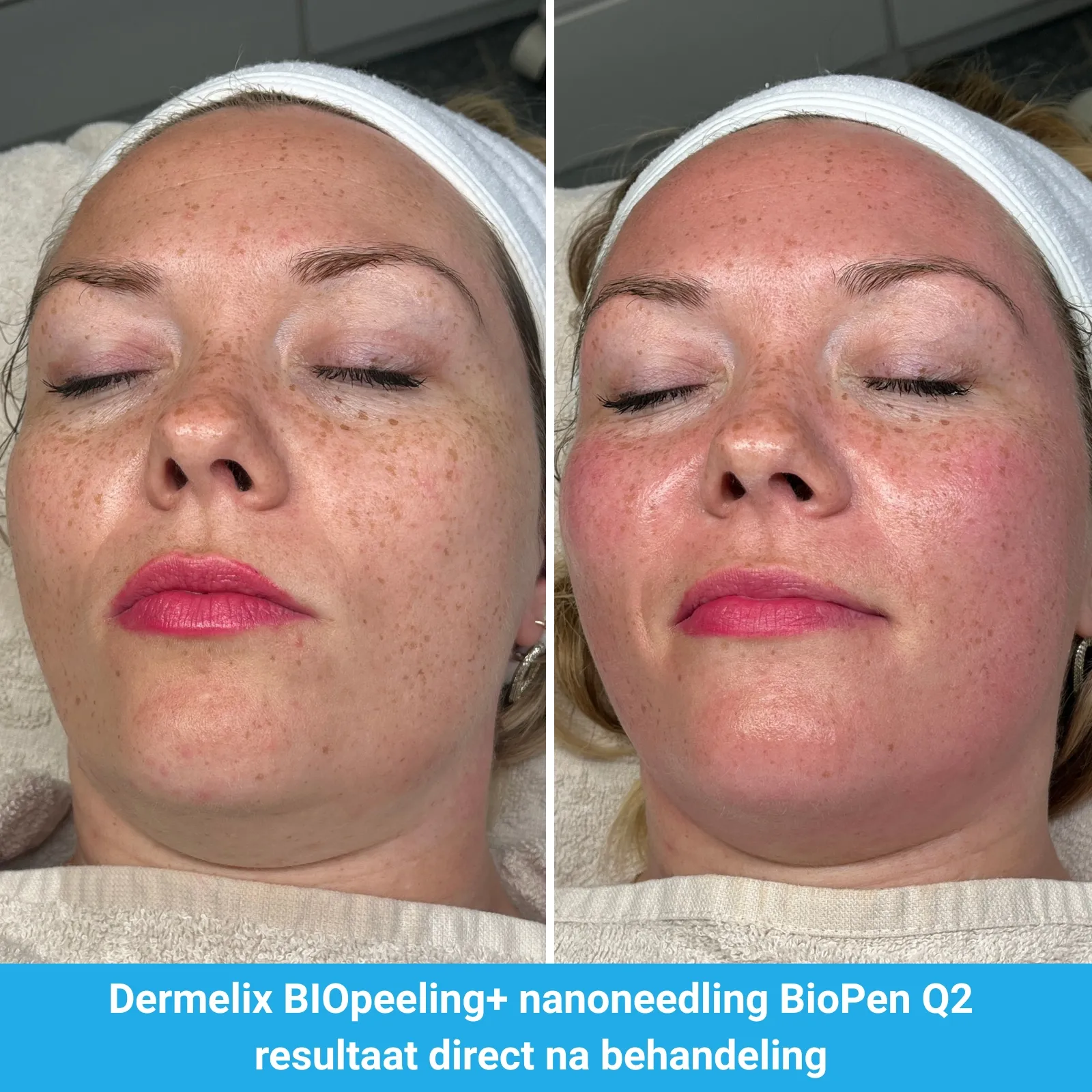 resultaten BioPeelig met Dermelix BP-002 – 20% PMPS Algen Peeling I (Groen) en nanoneedling met BioPen Q2-Beauty Skin Go-M01-voor en direct na behandeling-01